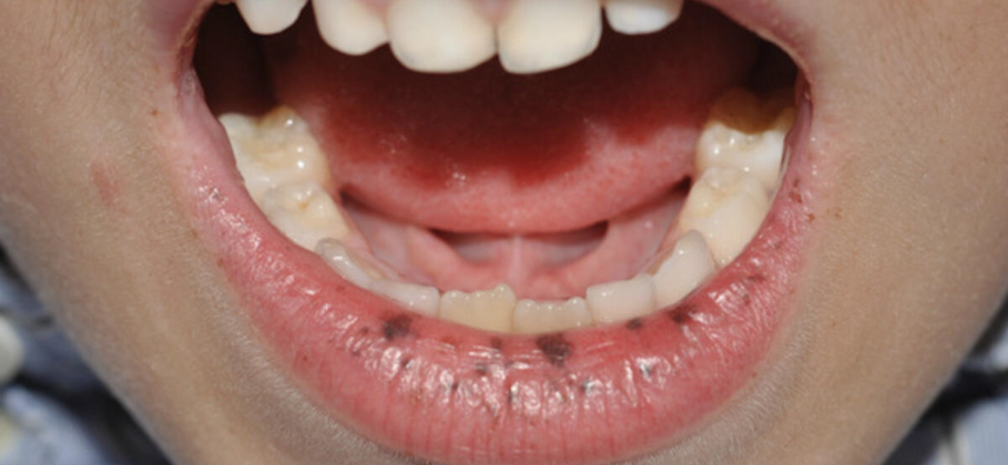 متلازمة بويتزجيغرز