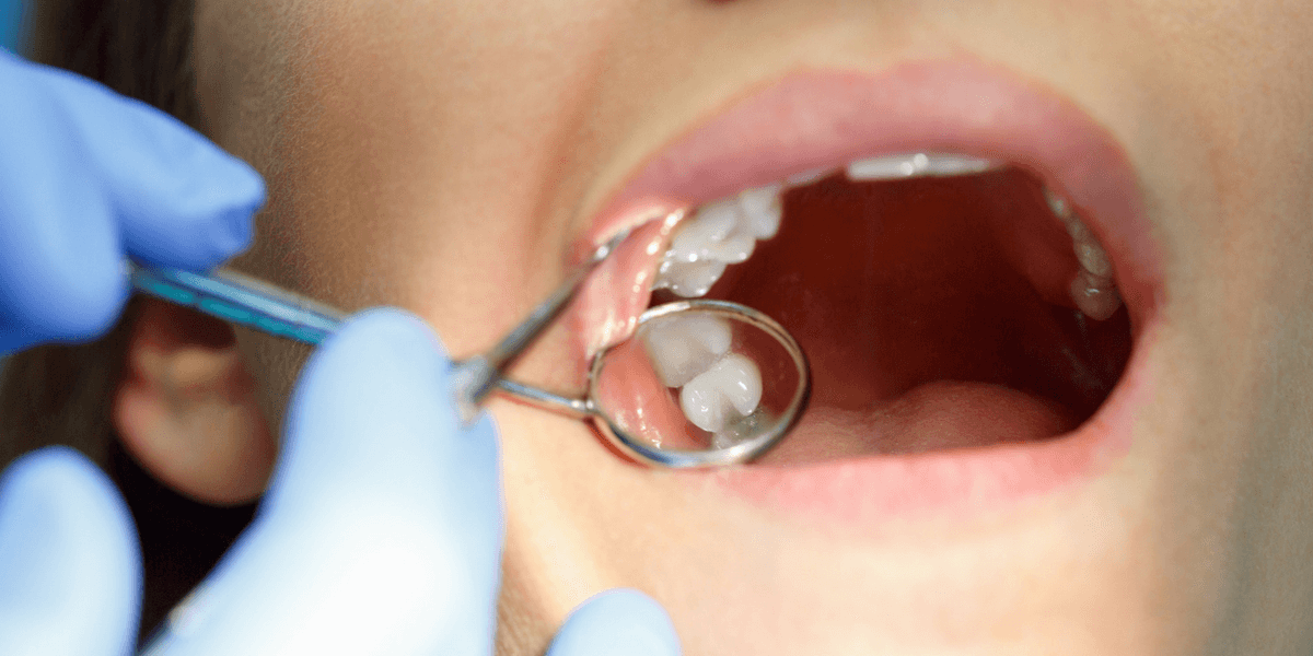 حشو الاسنان