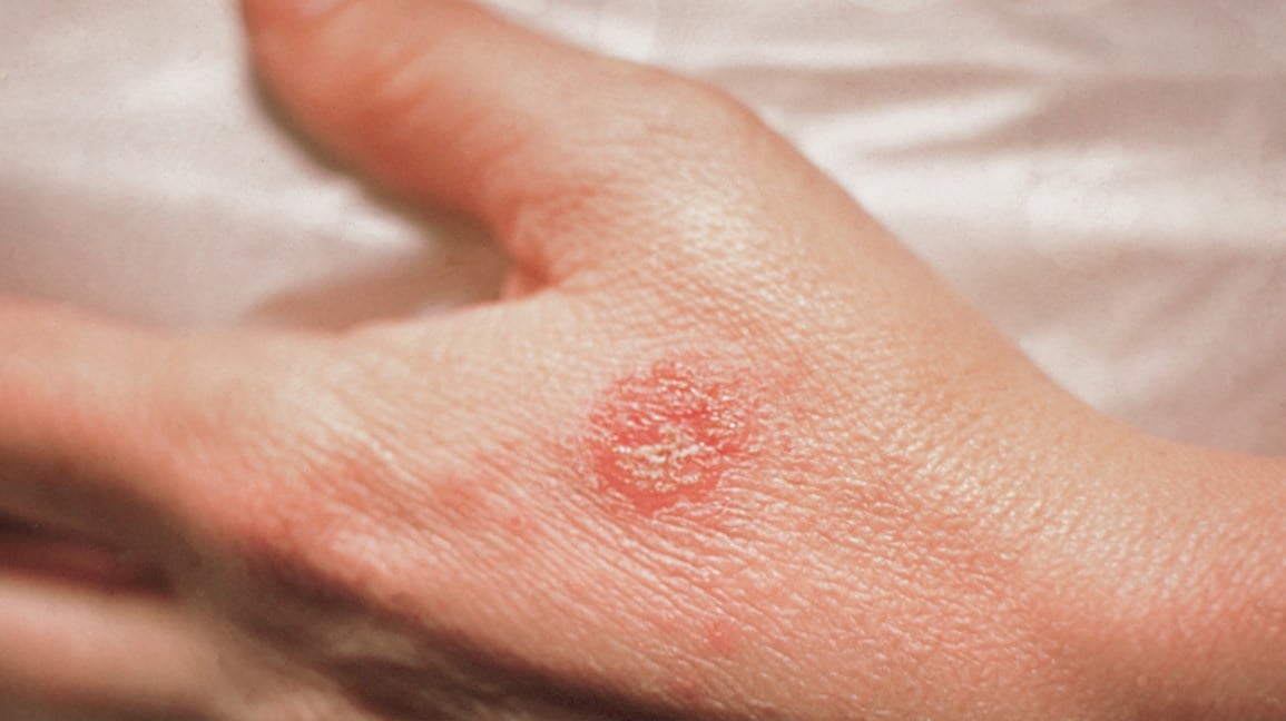 التهاب الجلد الدرهمي من انواع التهاب الجلد بالصور