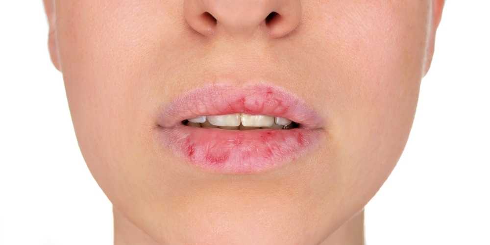 تشقق الشفاه