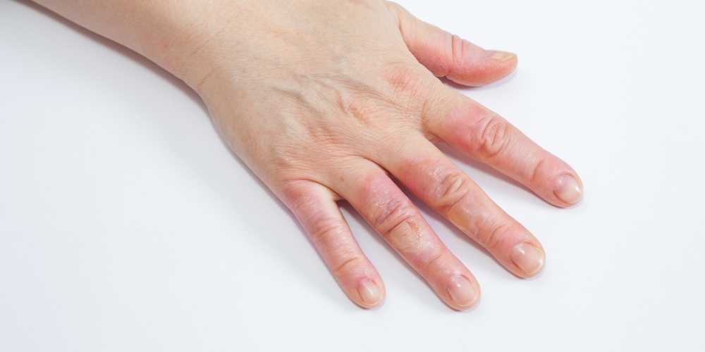 حرق من الدرجة الثانية