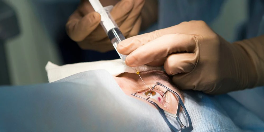 تصحيح النظر