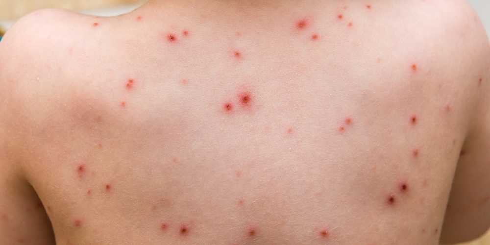 جدري القرود