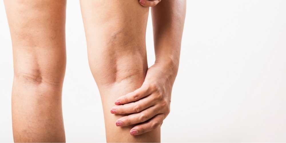 خثار الاوردة العميقة