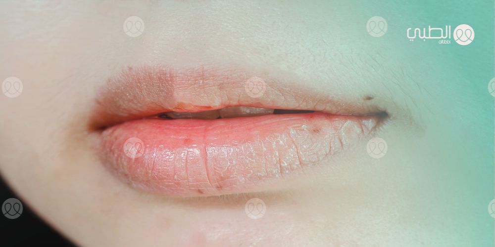 جفاف الشفاه