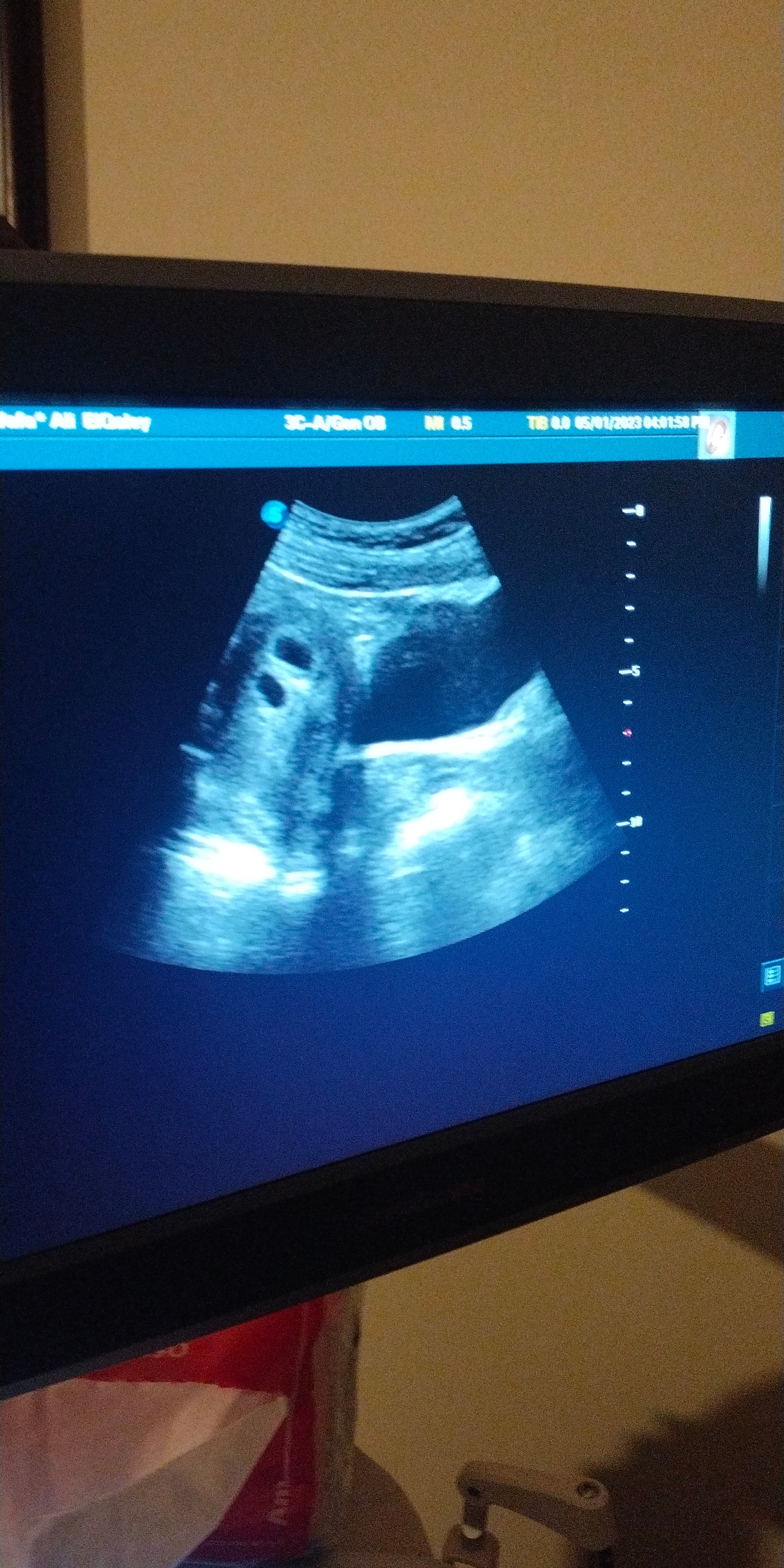 علامات تميز جنين التوأم في الأسبوع الخامس من الحمل - اختبارات السونار والتصوير بالرنين المغناطيسي