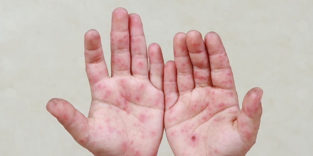 حمة كوكساكية