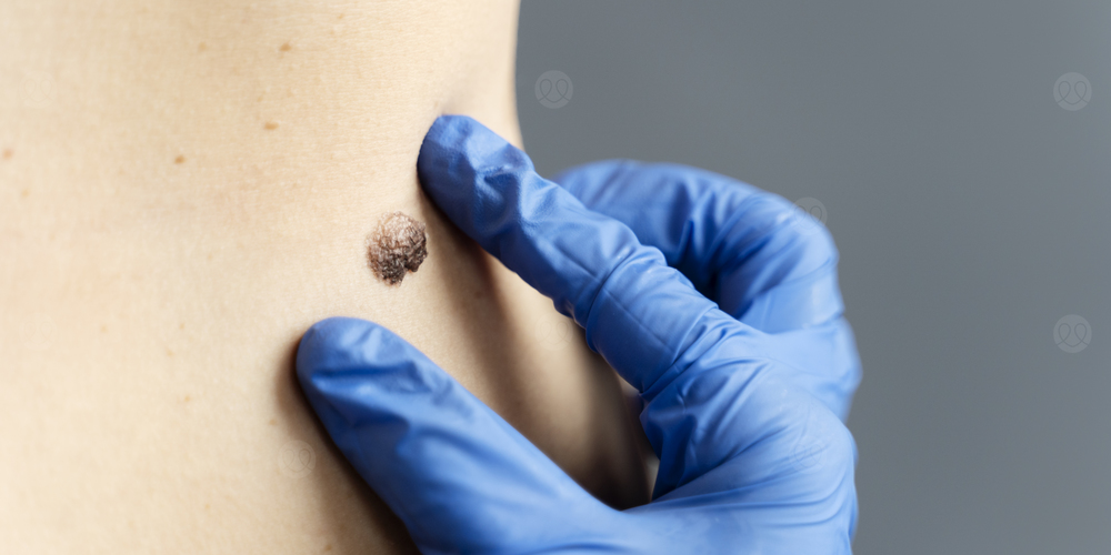 ورم ميلانيني خبيث