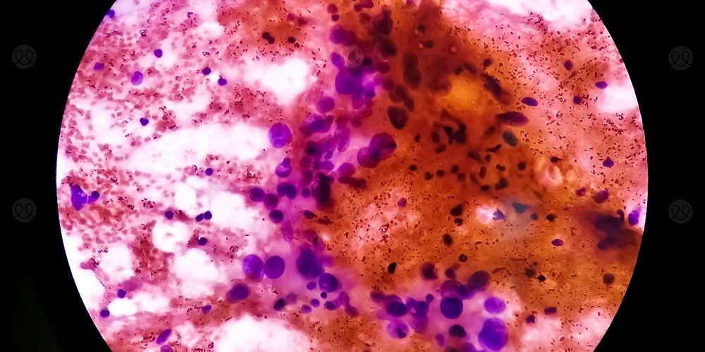 ساركوما خلايا المغزل