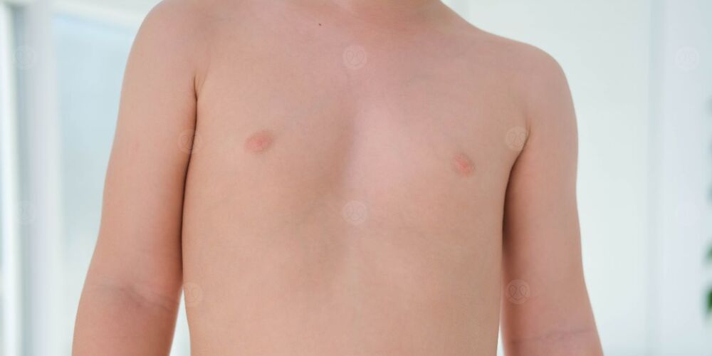 بيلة هوموسستينية