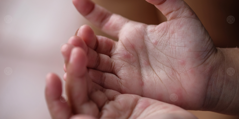 داء اليد و القدم و الفم