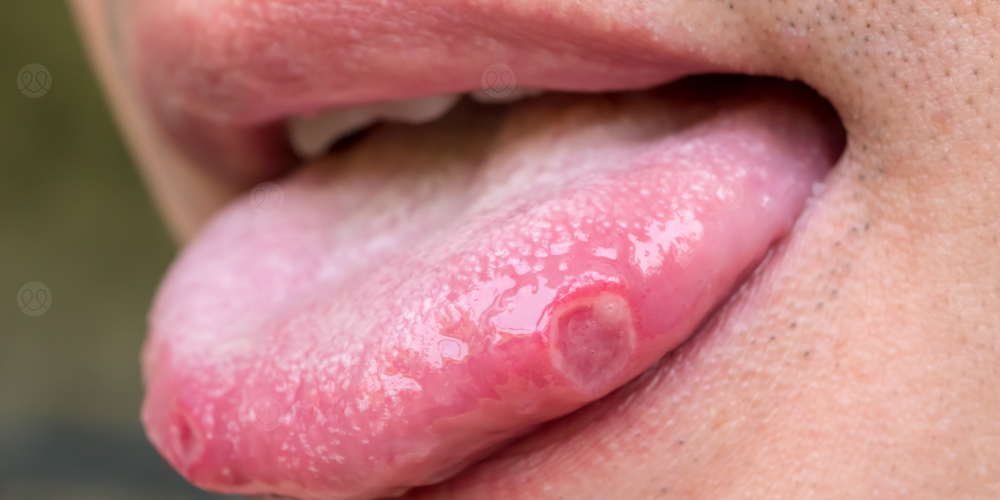 تقرحات اللسان