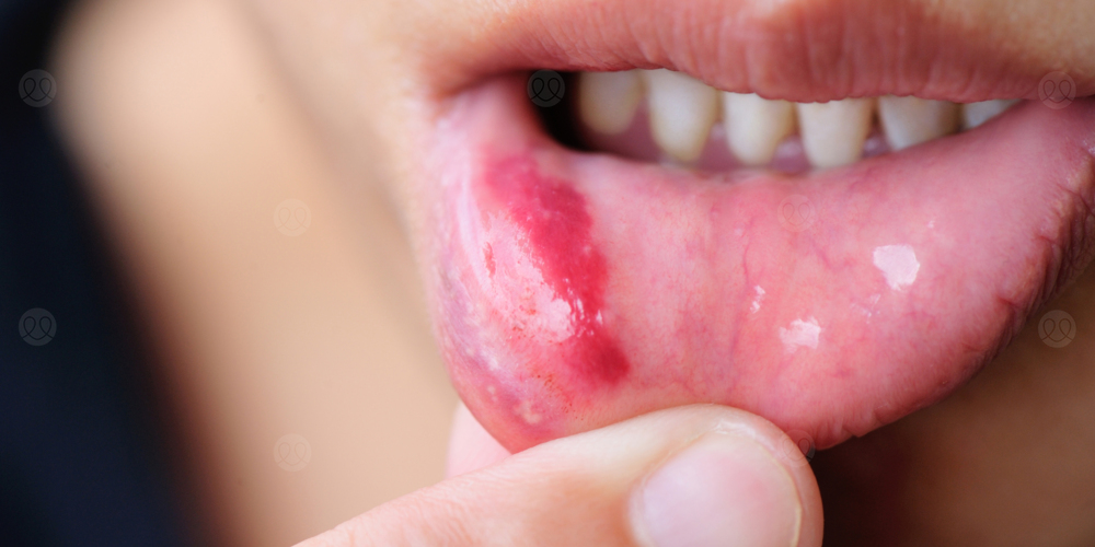 تقرحات الشفاه