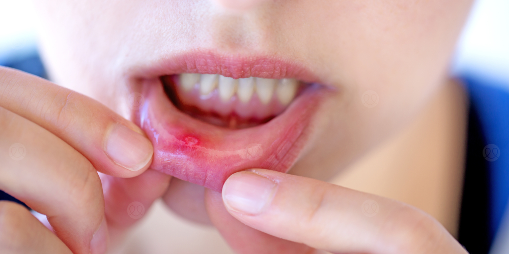 التهاب الفم