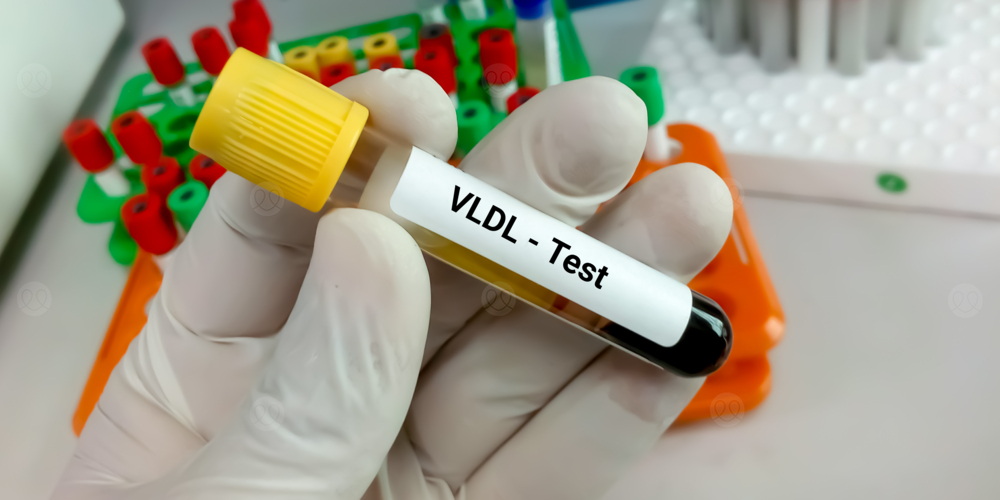 البروتين الدهني منخفض الكثافة جدا