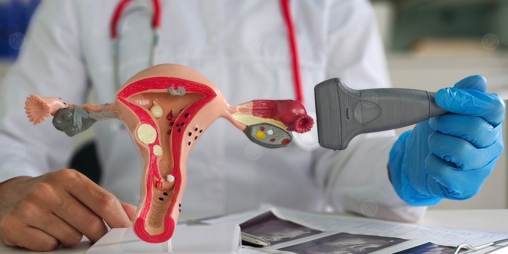 انقلاب عنق الرحم