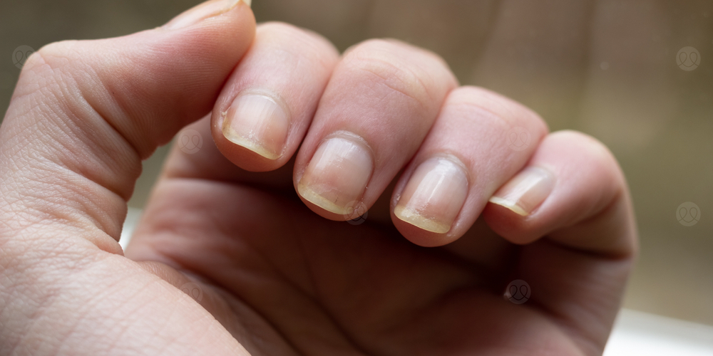 اصفرار الاظافر