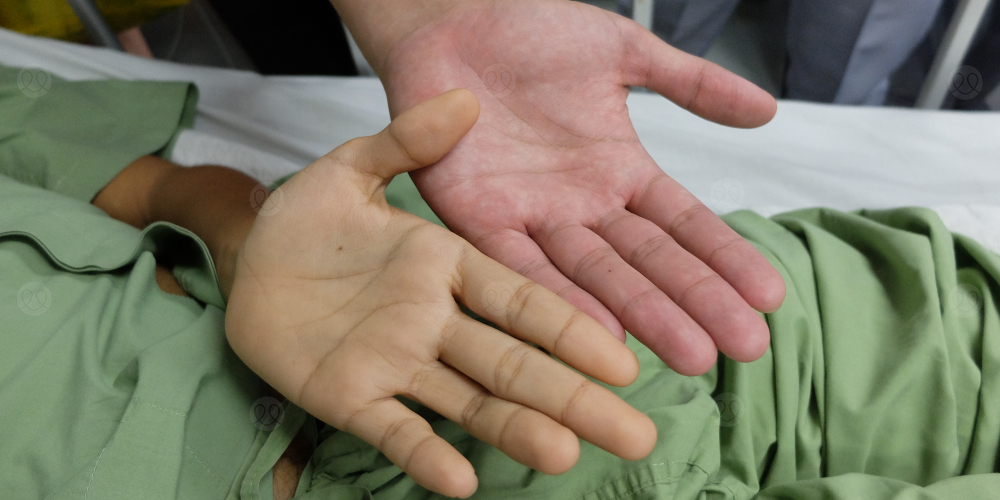 اصفرار اليدين