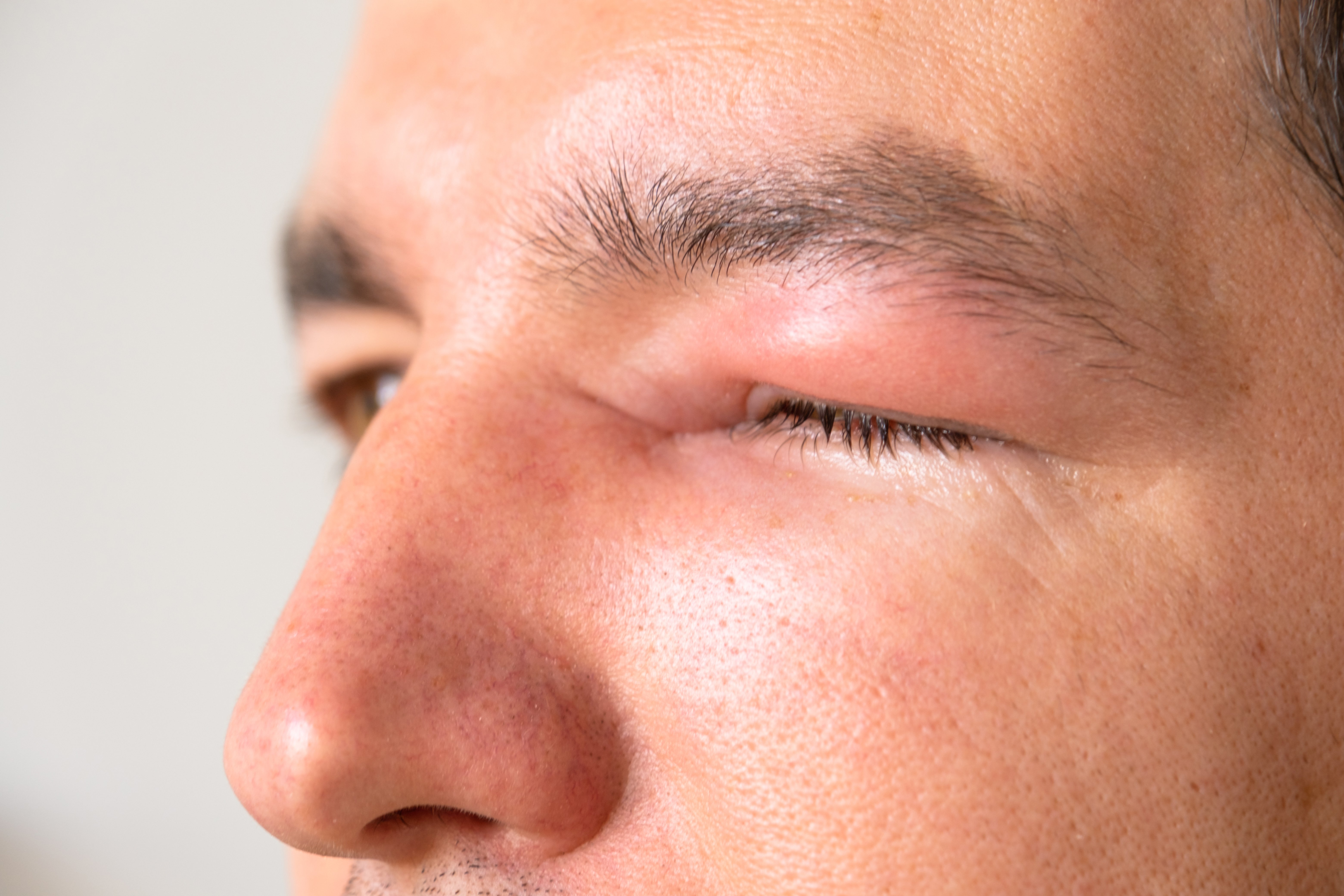 6. دمل العين (Stye)