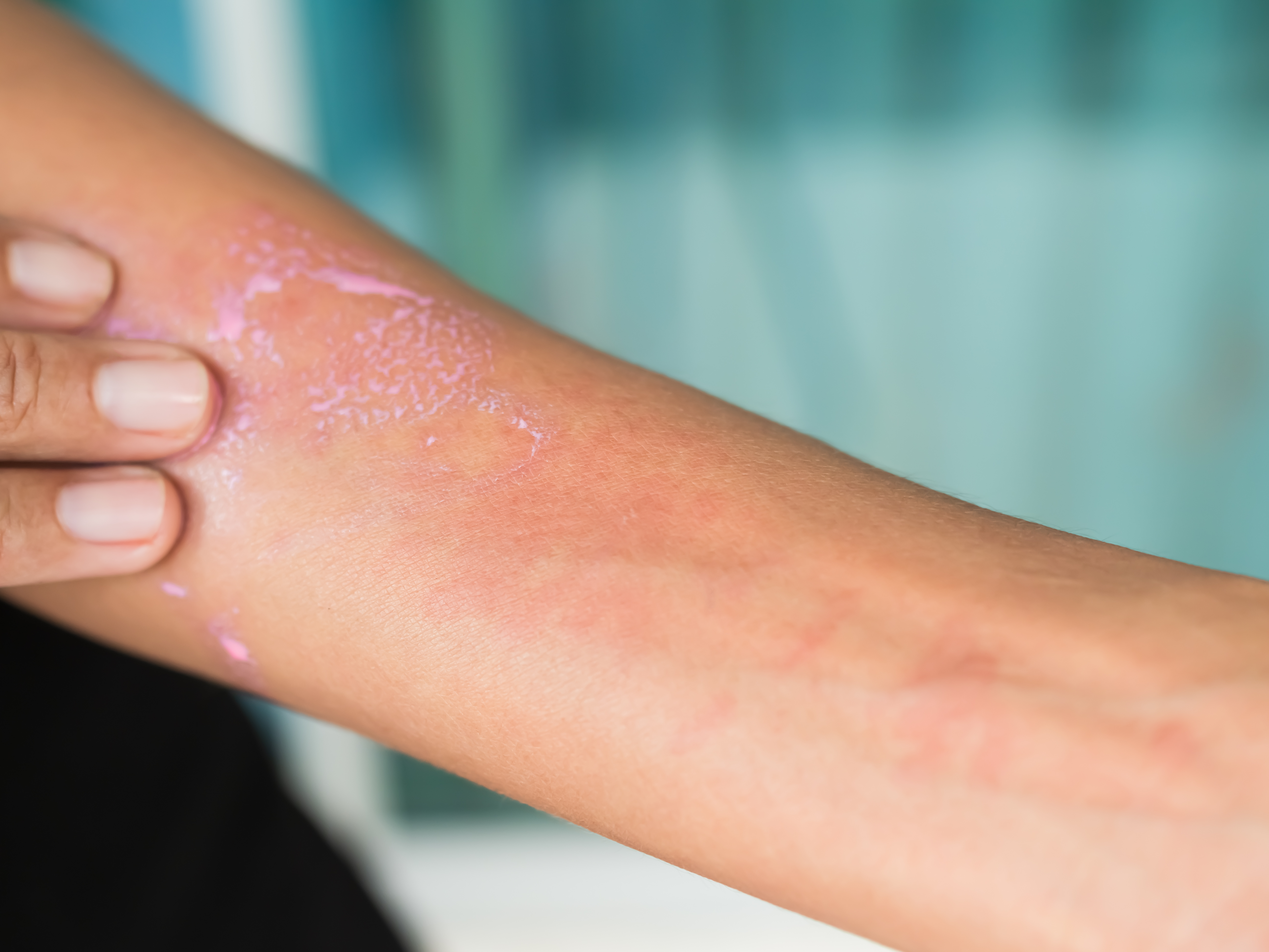 1. التهاب الجلد التلامسي (Contact Dermatitis)