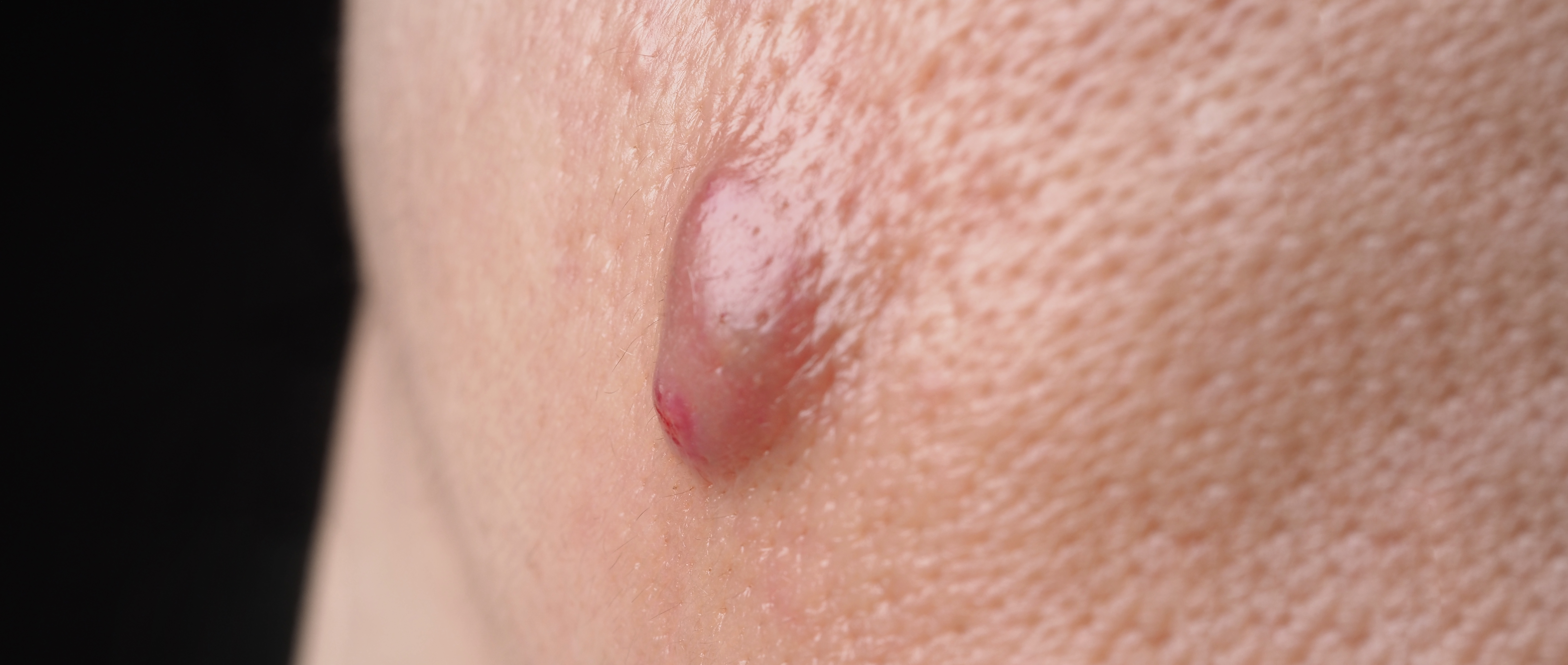 3. كيس الشعر (Pilonidal Cyst)