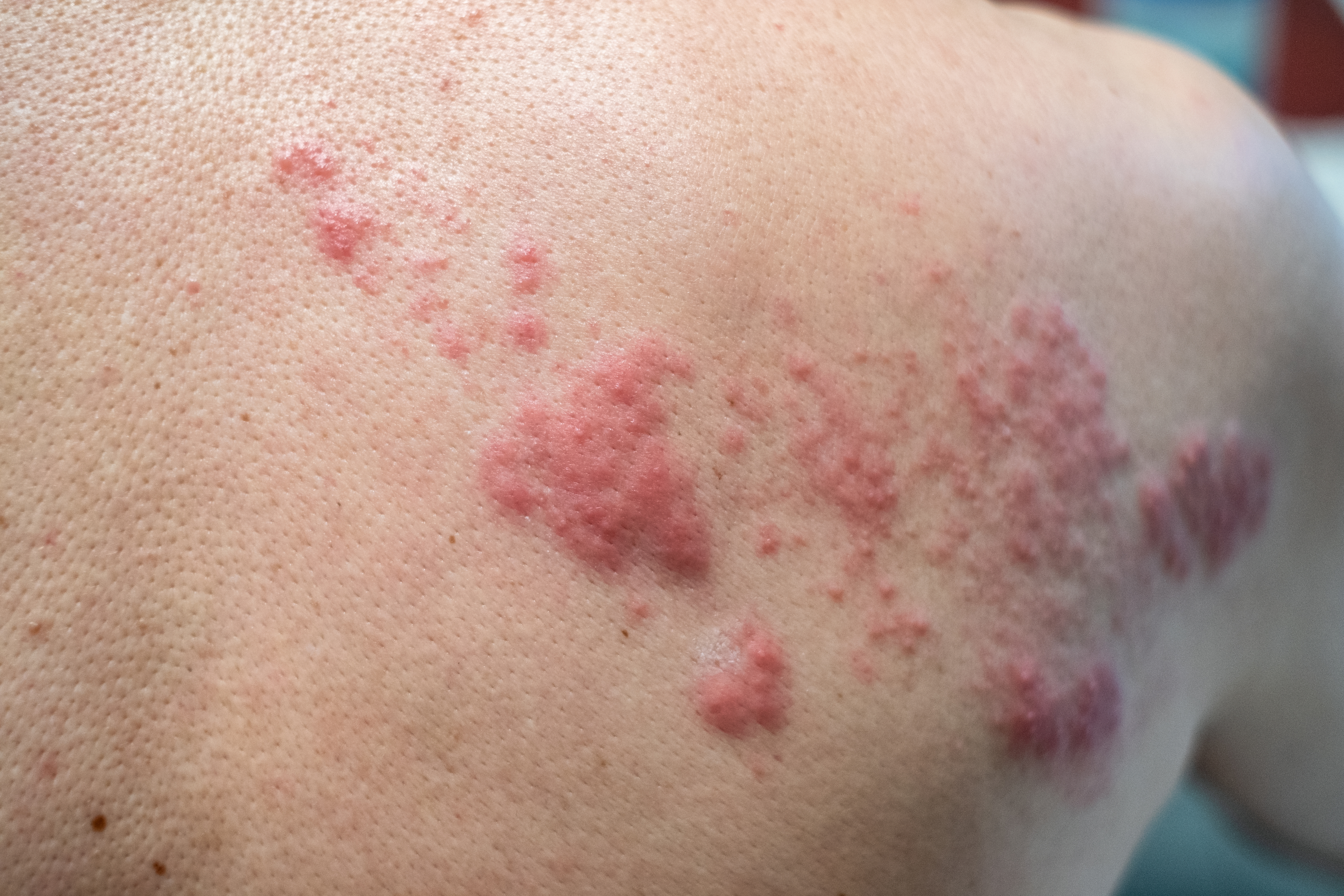 5. التهاب الغدد العرقية القيحي (Hidradenitis Suppurativa)