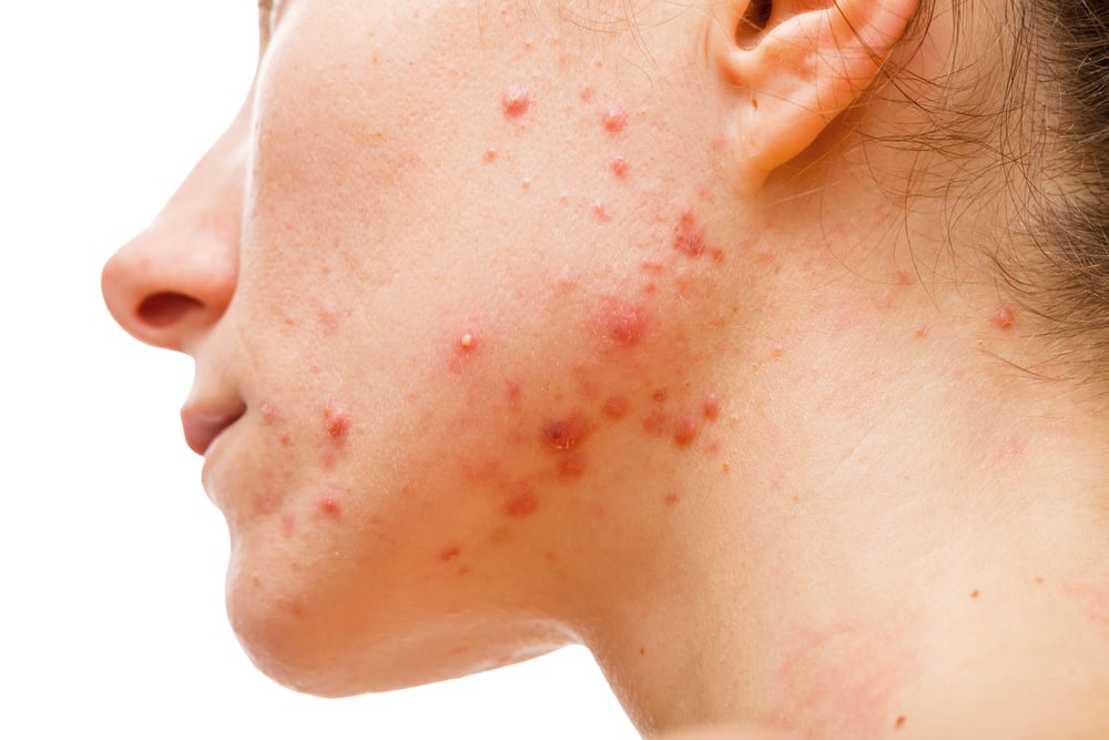 4. حب الشباب الكيسي (Cystic Acne)
