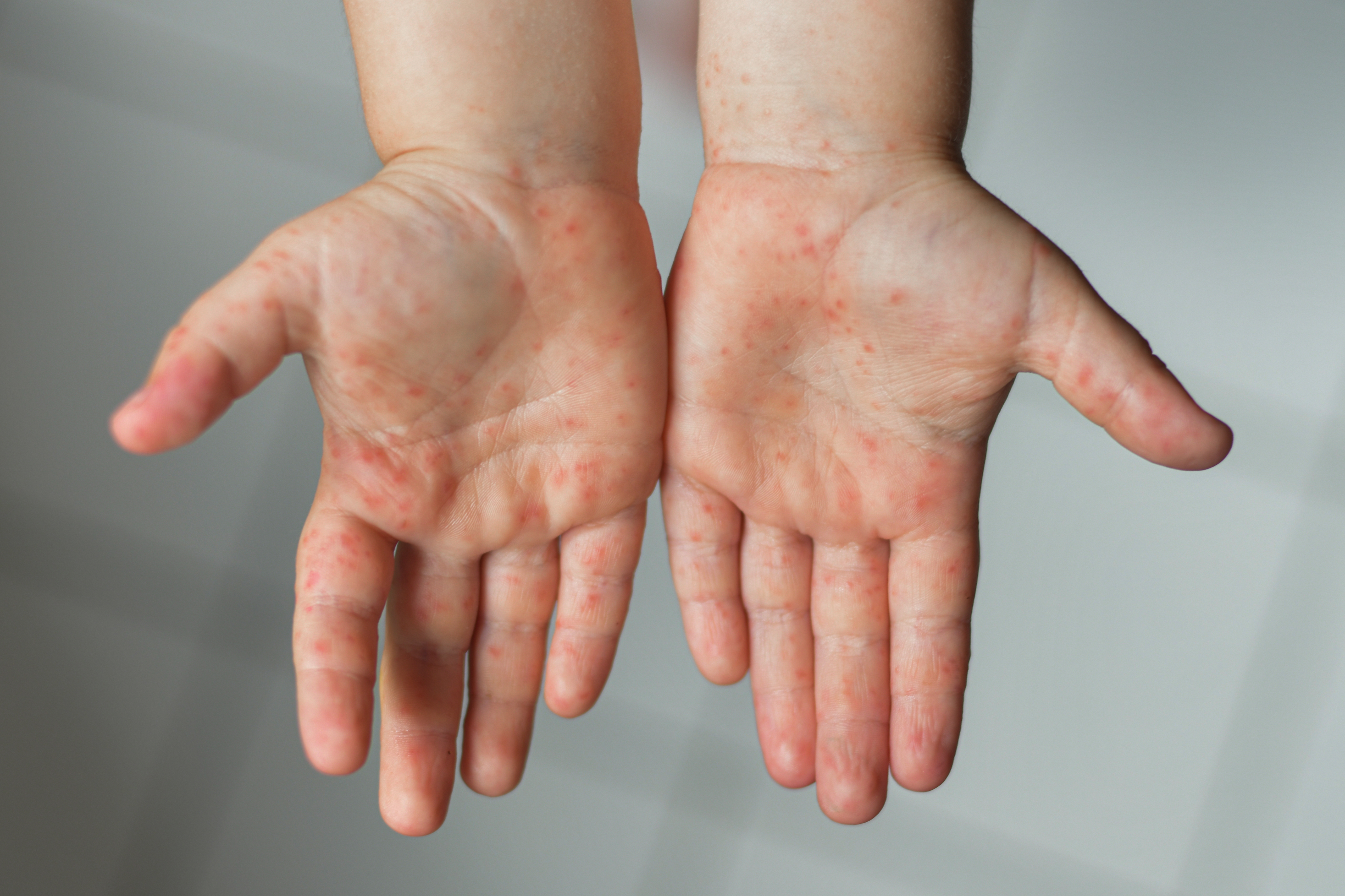 2. الإكزيما (Eczema) أو التهاب الجلد التأتبي