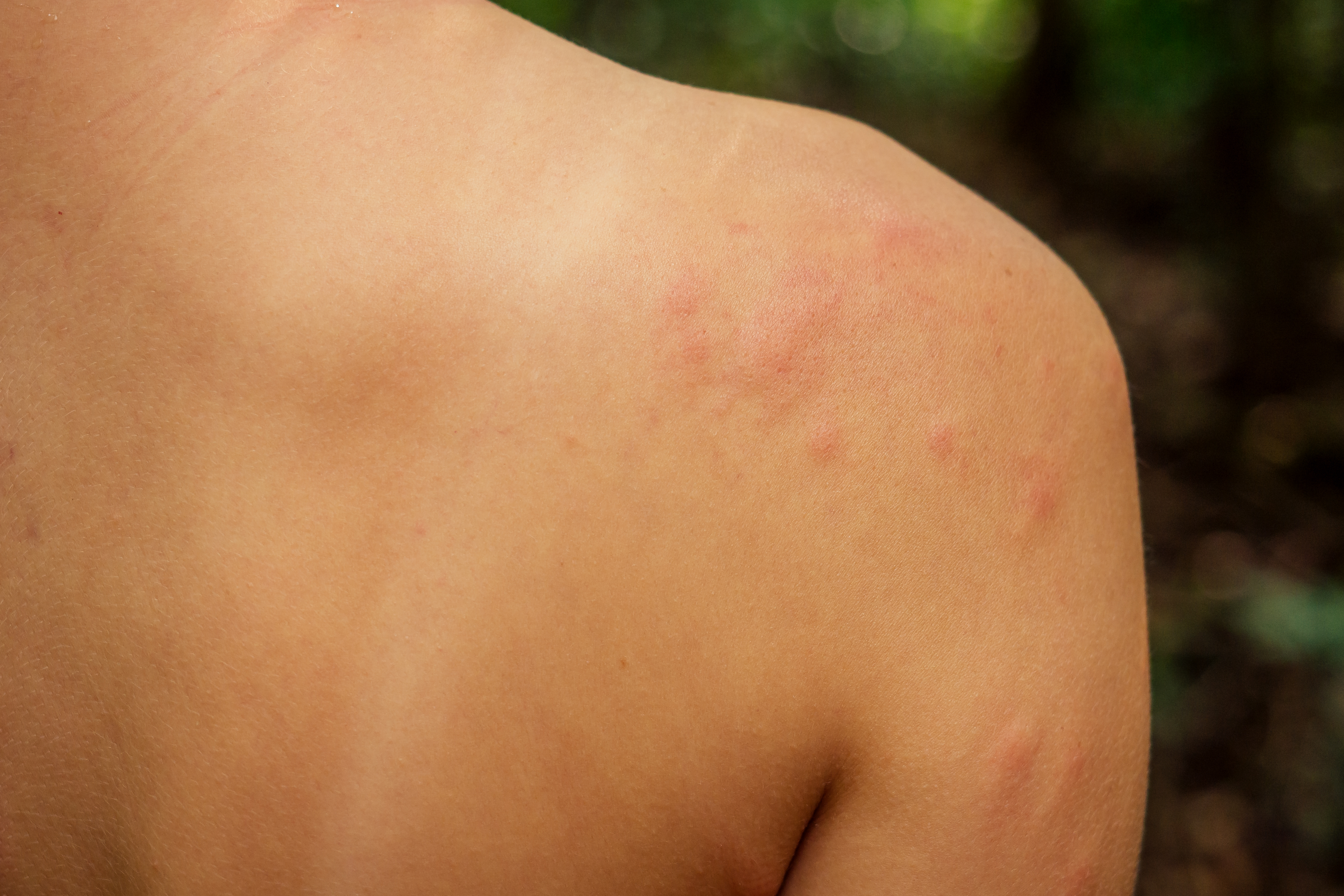 3. الشرى أو الأرتيكاريا (Hives)