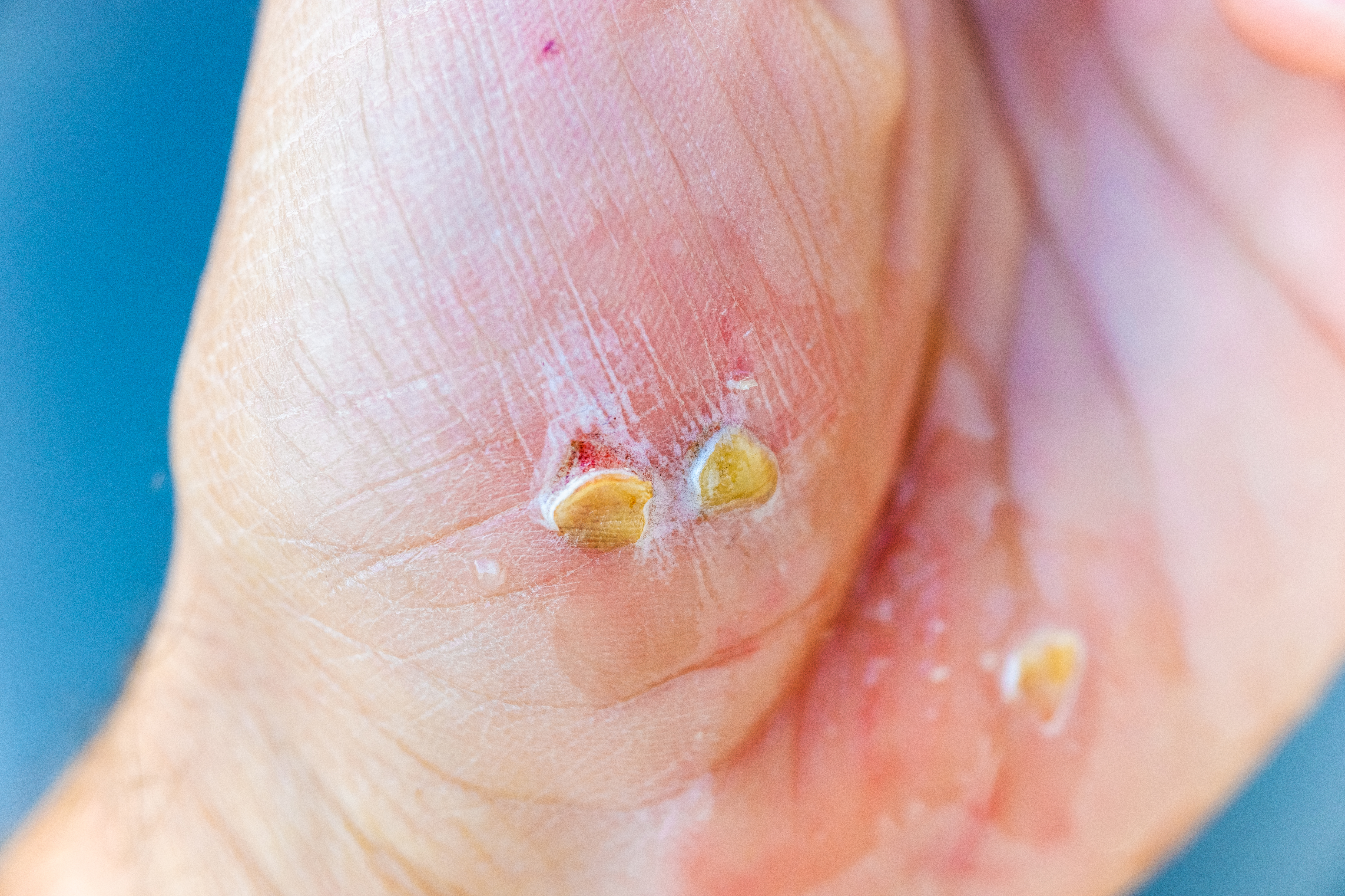 1. سعفة الجسم (Ringworm)