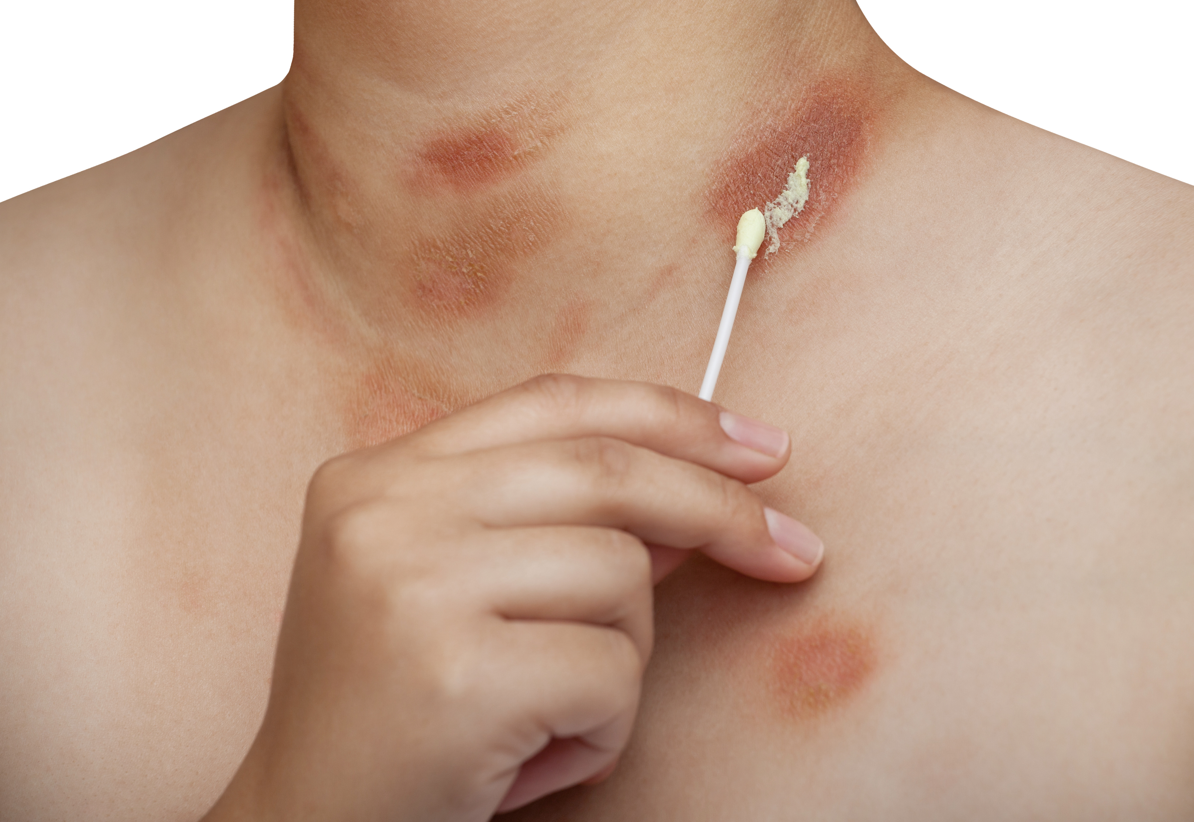 7. النخالية المبرقشة (Pityriasis versicolor)