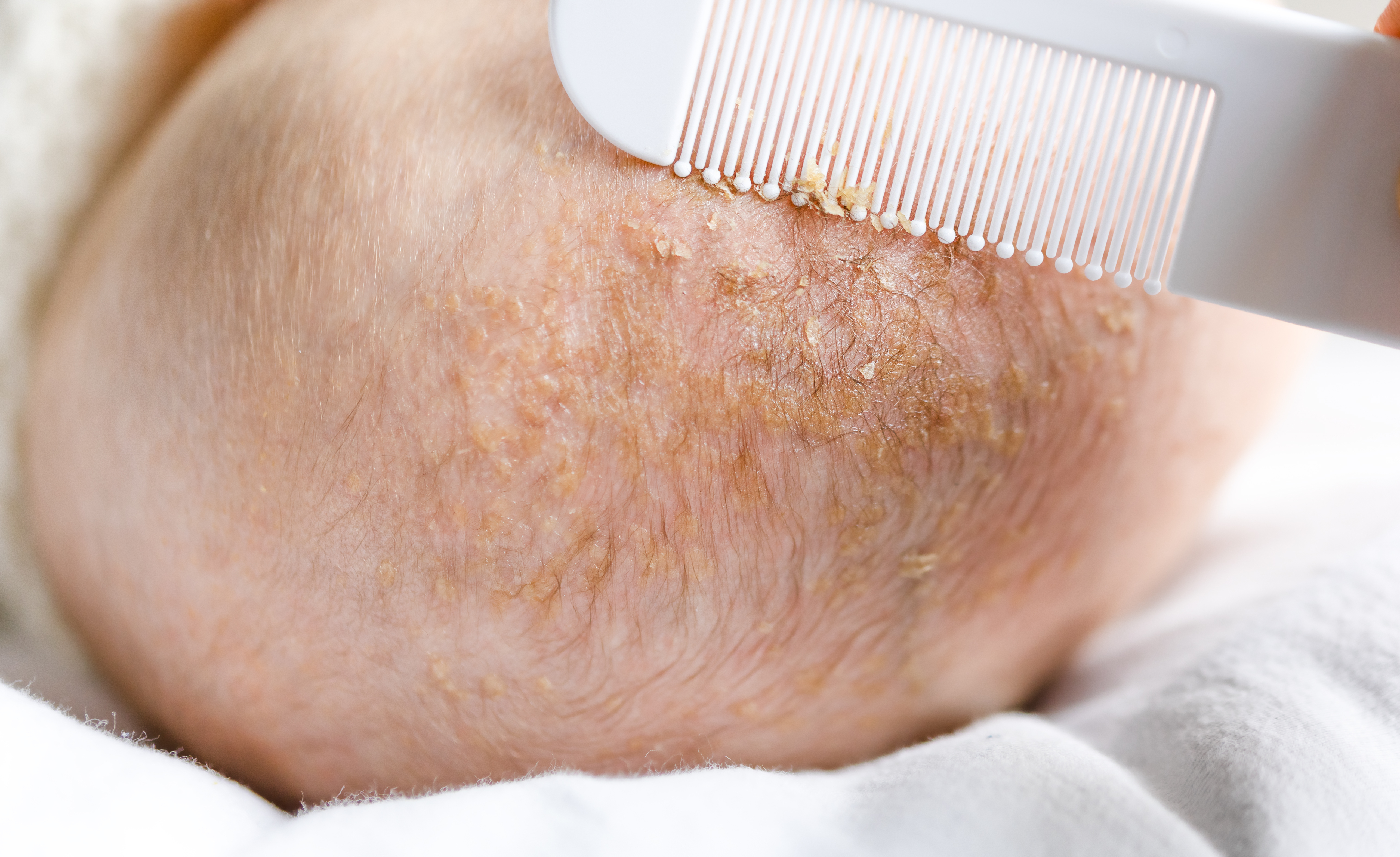 1. قبعة المهد (Cradle Cap)