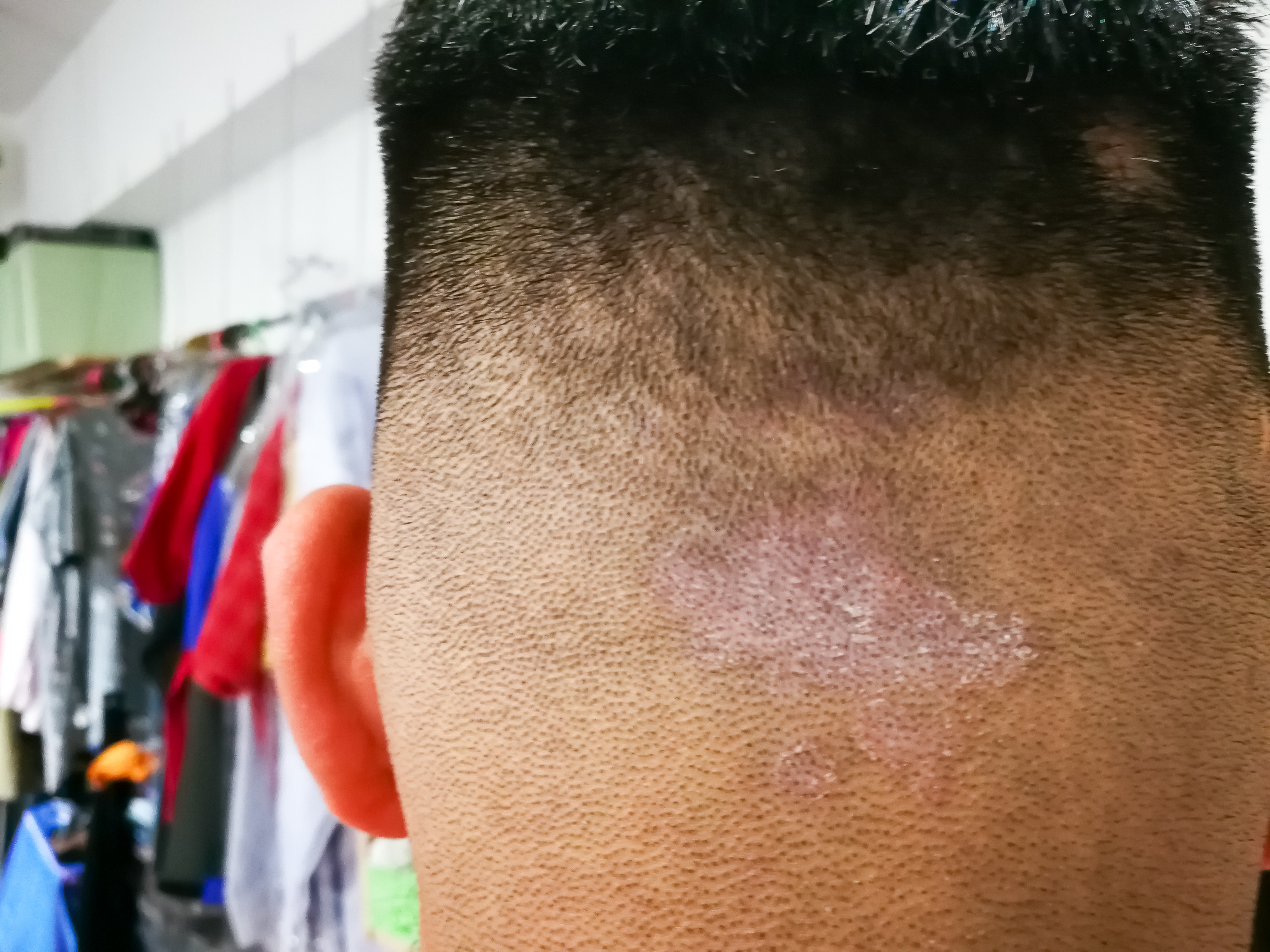4. سعفة الرأس (Ringworm of the Scalp)