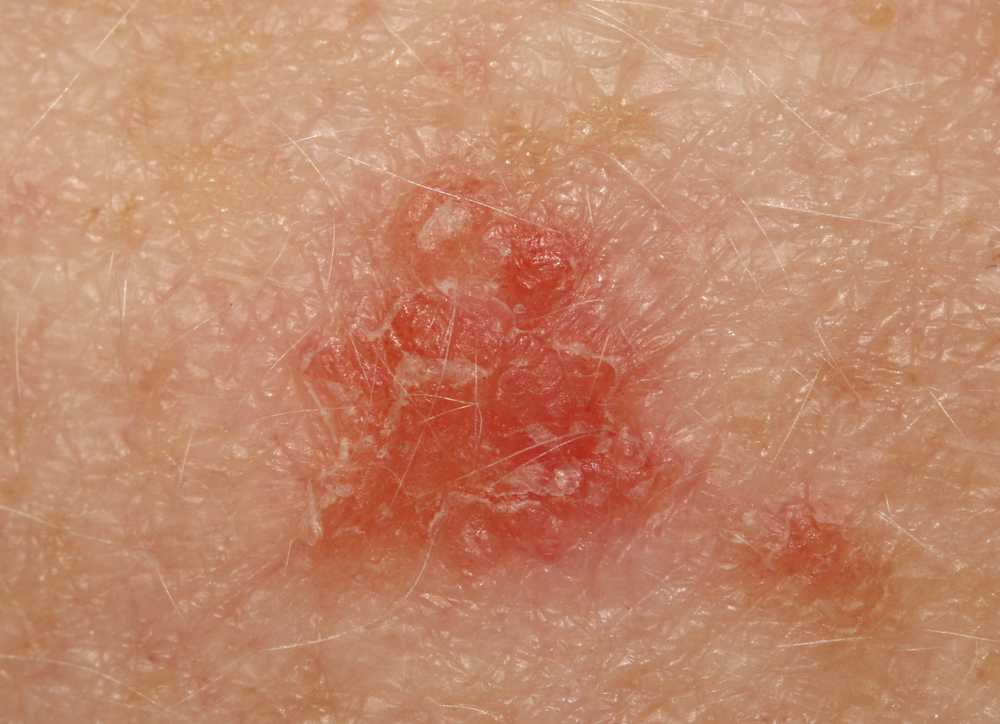 3. حكة اللعب (Jock itch)