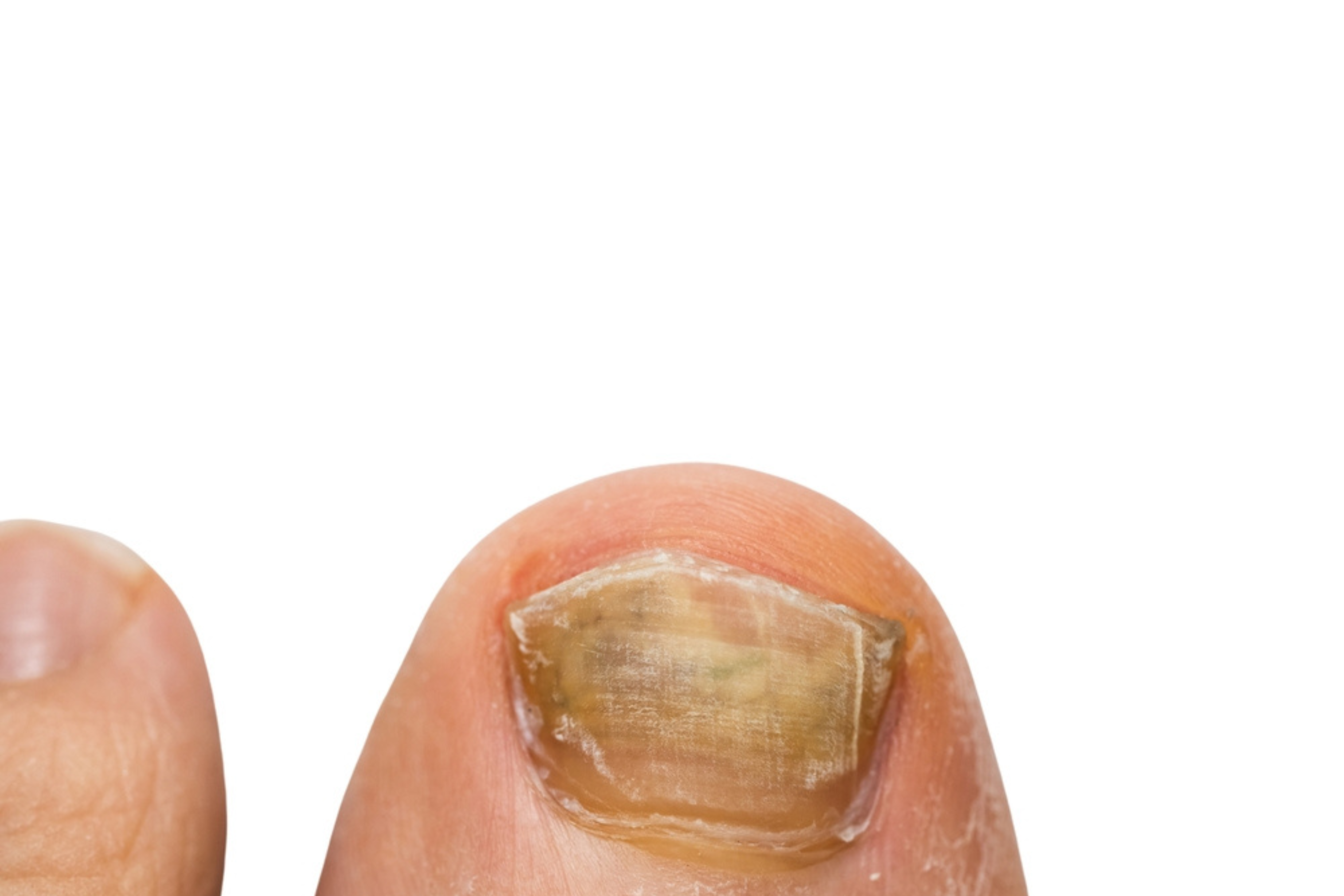 6. فطريات الأظافر (Onychomycosis)