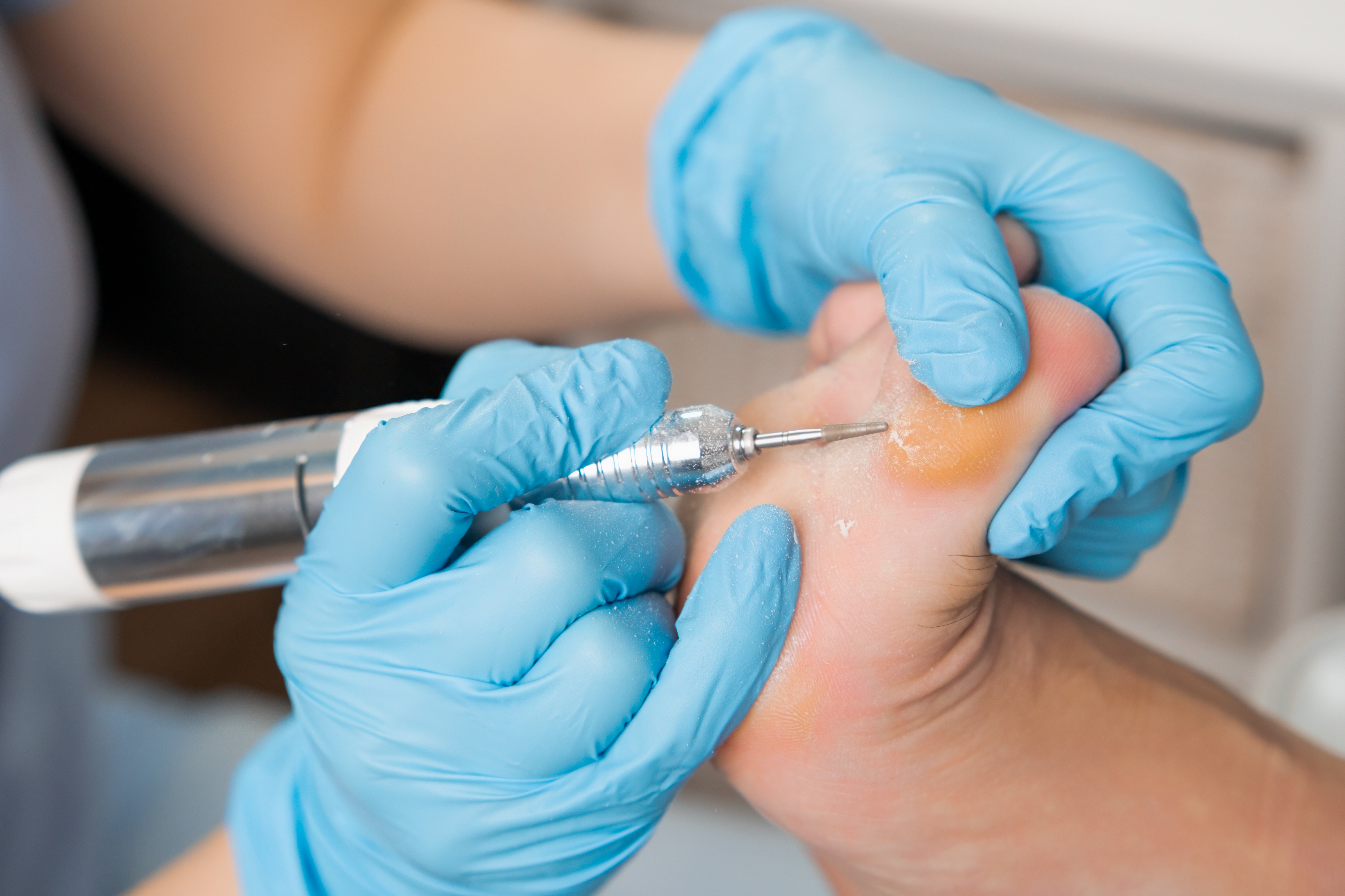 2. الثآليل الأخمصية (Plantar Warts)