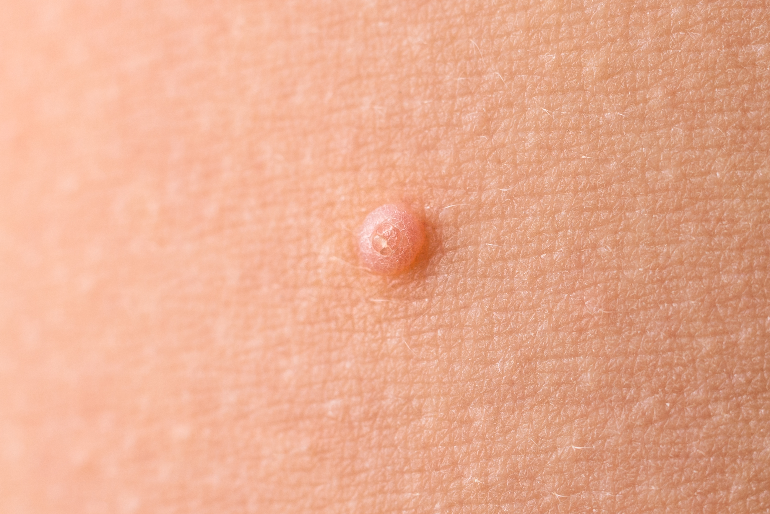 4. الثآليل التناسلية (Genital Warts)