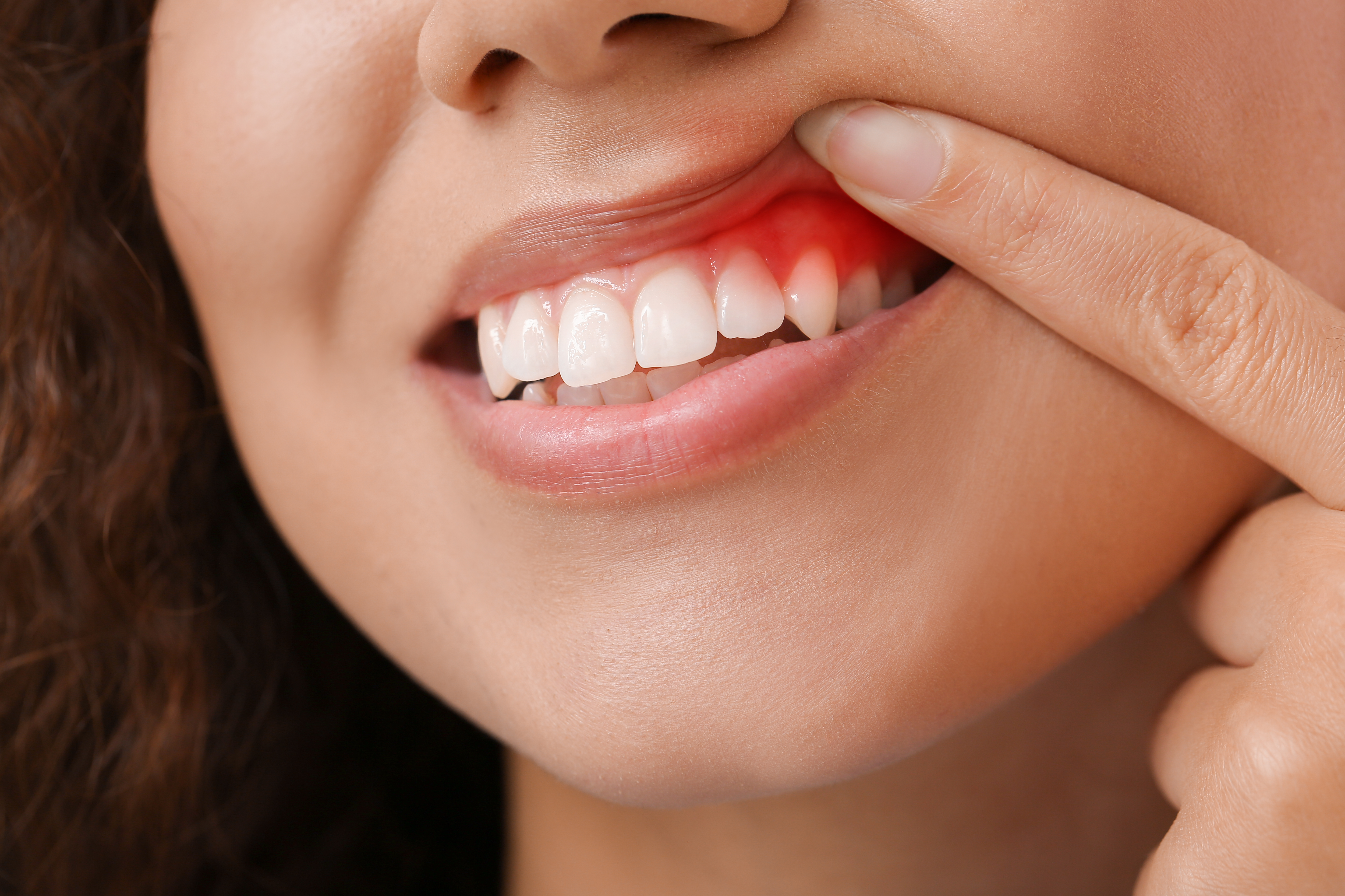أنواع وأعراض التهاب اللثة