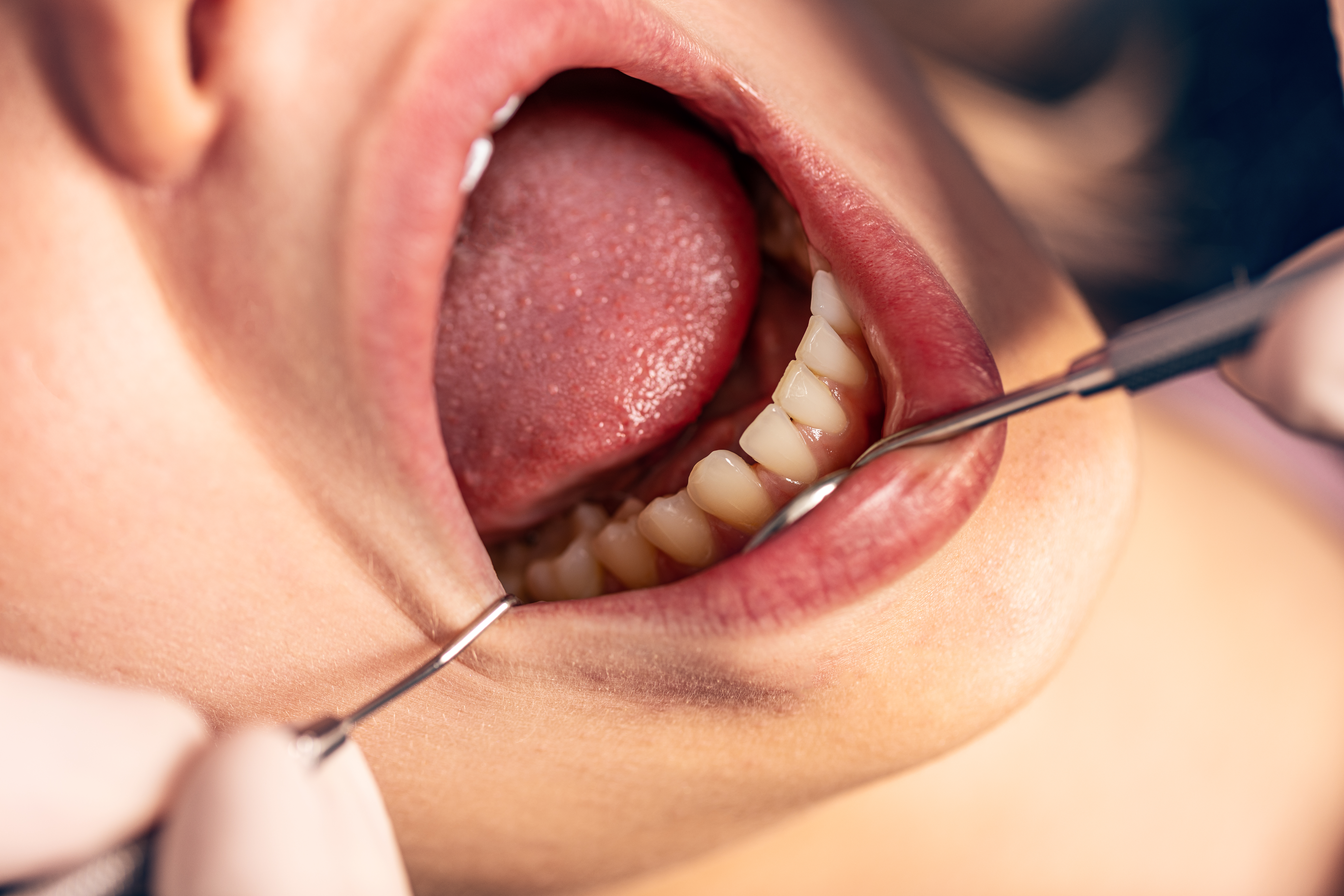 5. التهاب دواعم السن (Periodontitis)