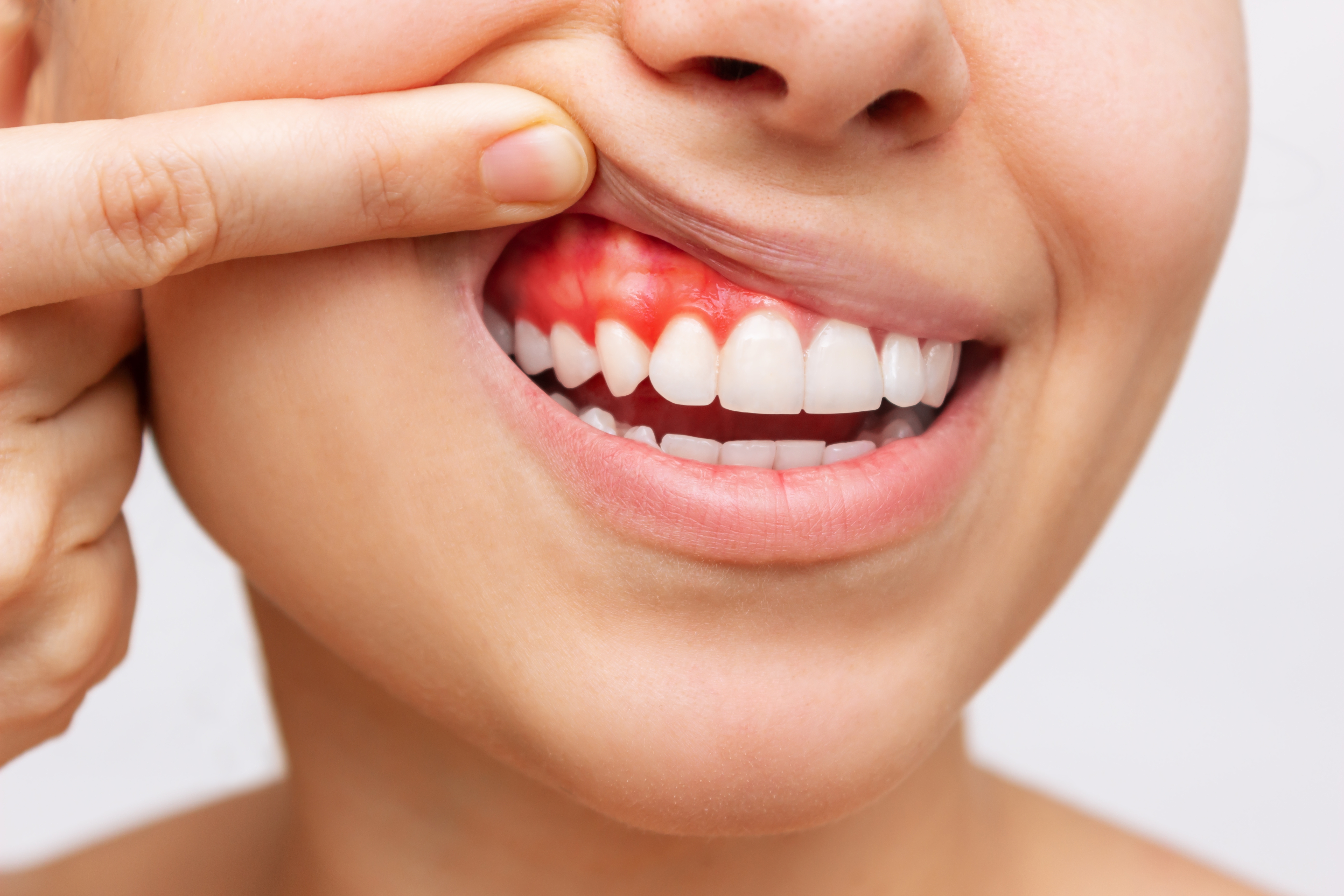 1. التهاب اللثة الناتج عن البلاك (Plaque Induced Gingivitis)