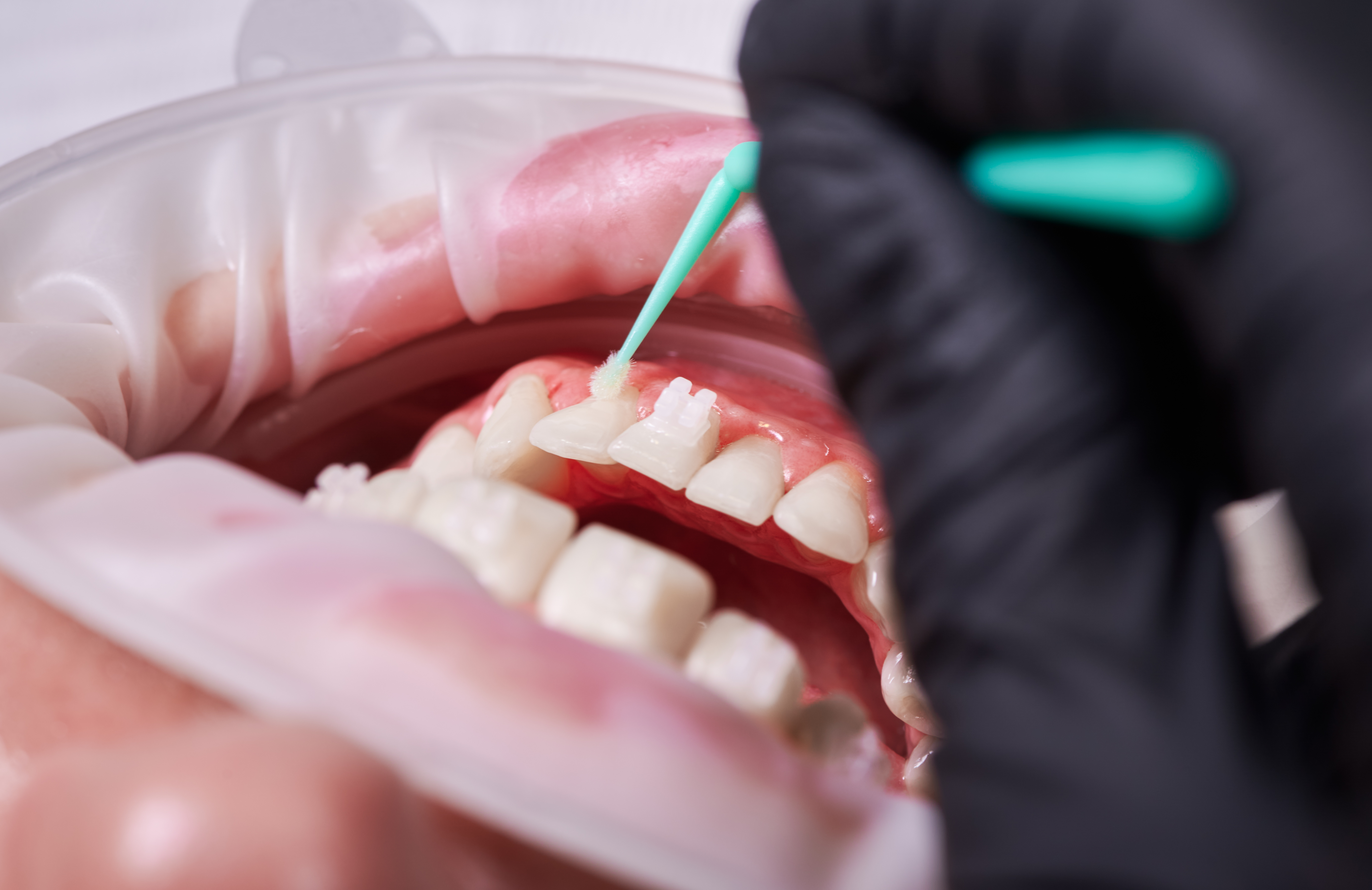 3. التهاب اللثة الهرموني (Hormonal Gingivitis)