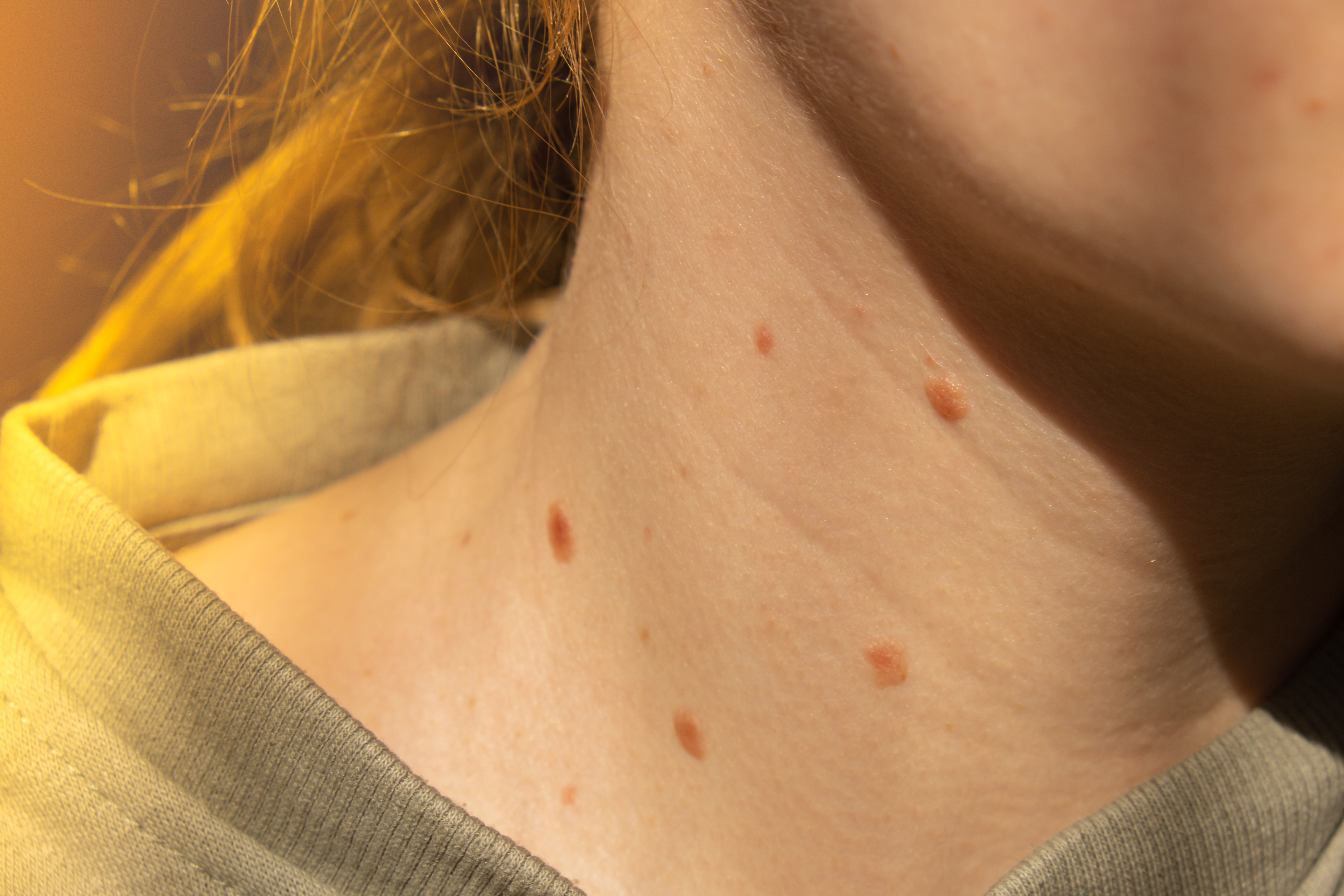 3. الثآليل المسطحة (Flat Warts)