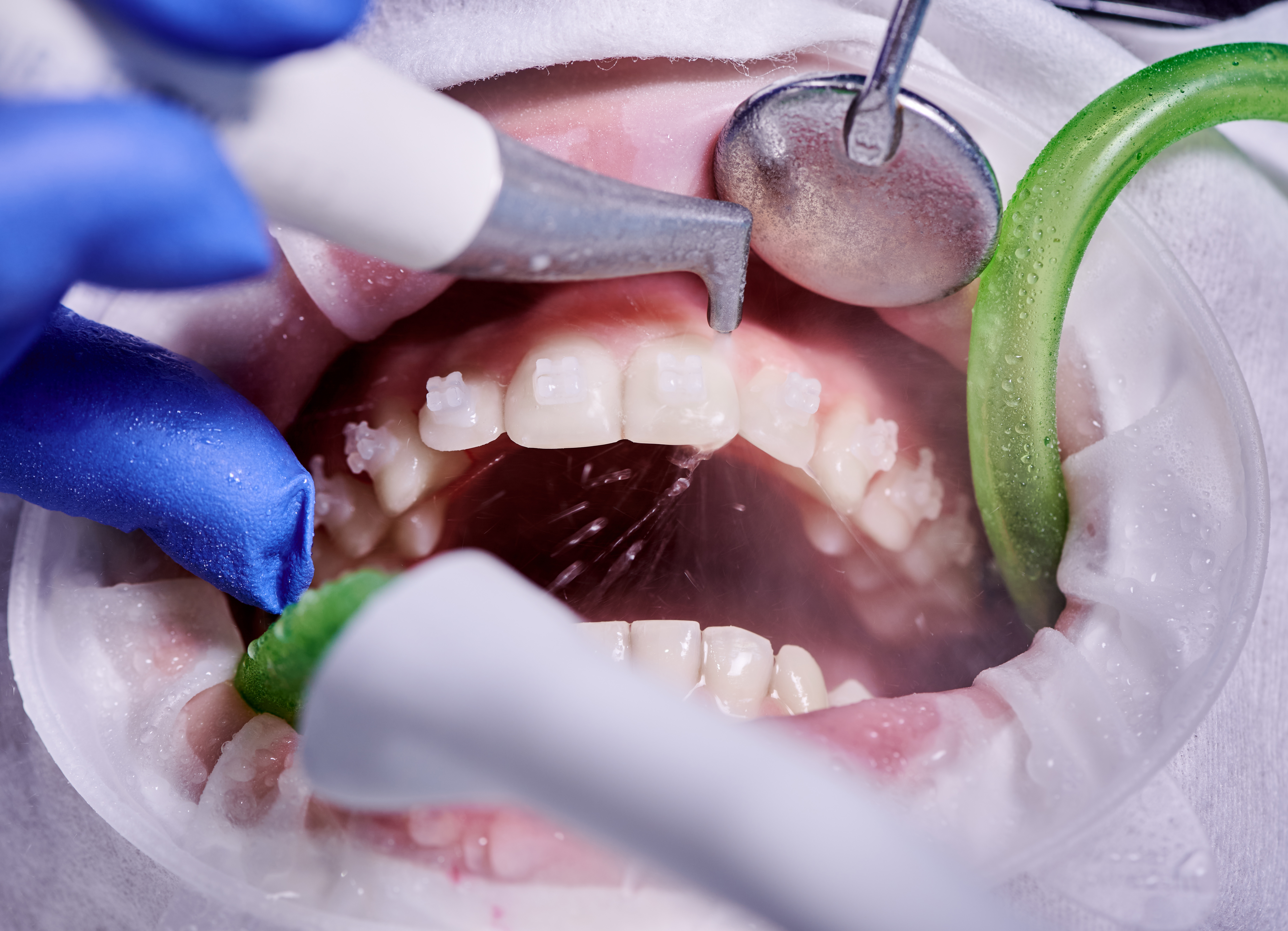 4. التهاب اللثة الناتج عن الأدوية (Drug-Induced Gingivitis)