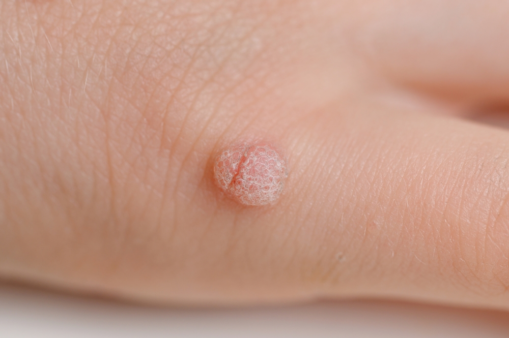 1. الثآليل الشائعة (Common Warts)