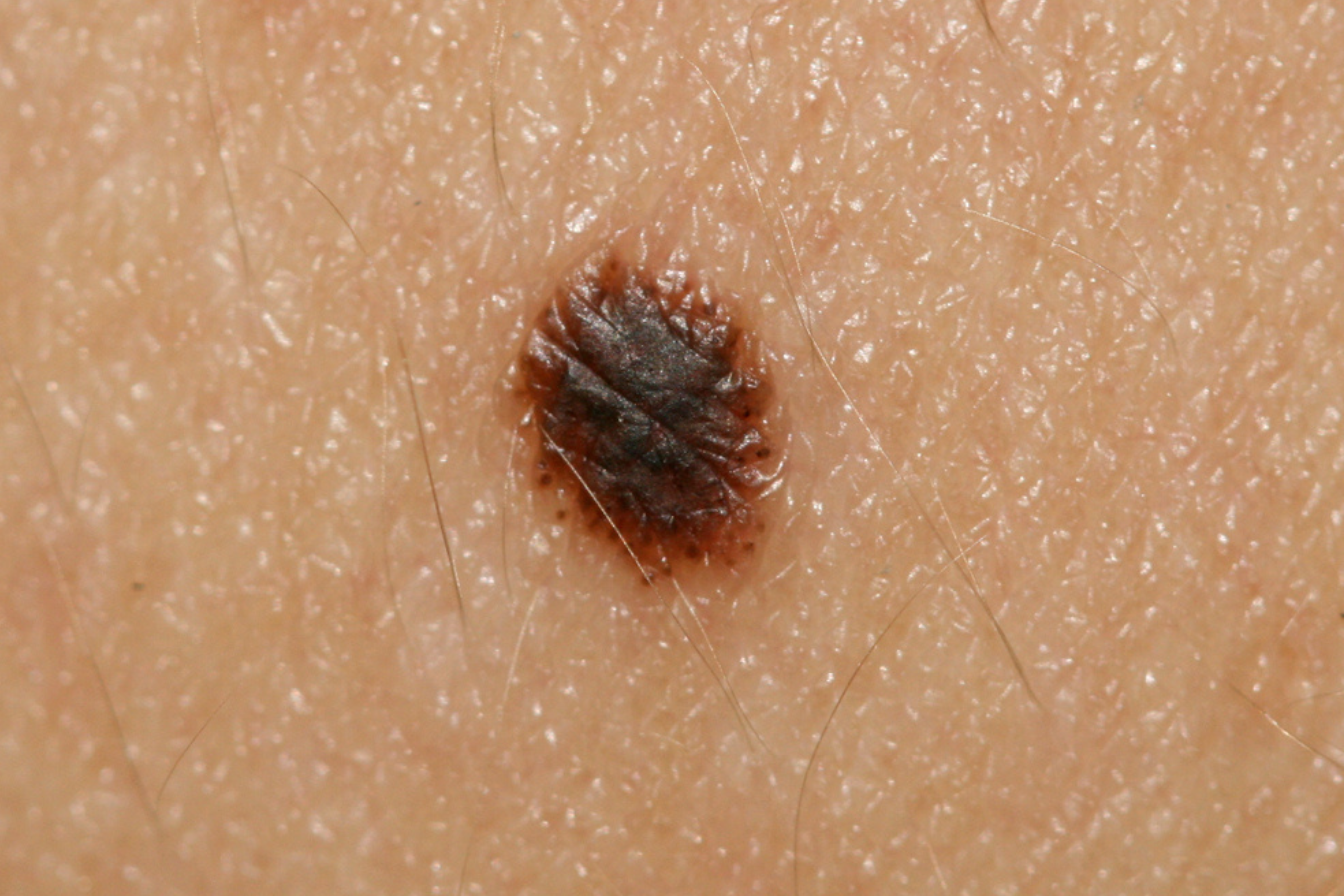 وحمة سبيتز (Spitz nevus)