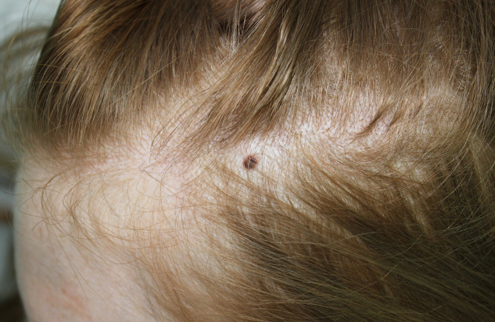 الشامات الخَلقية (Congenital nevi)