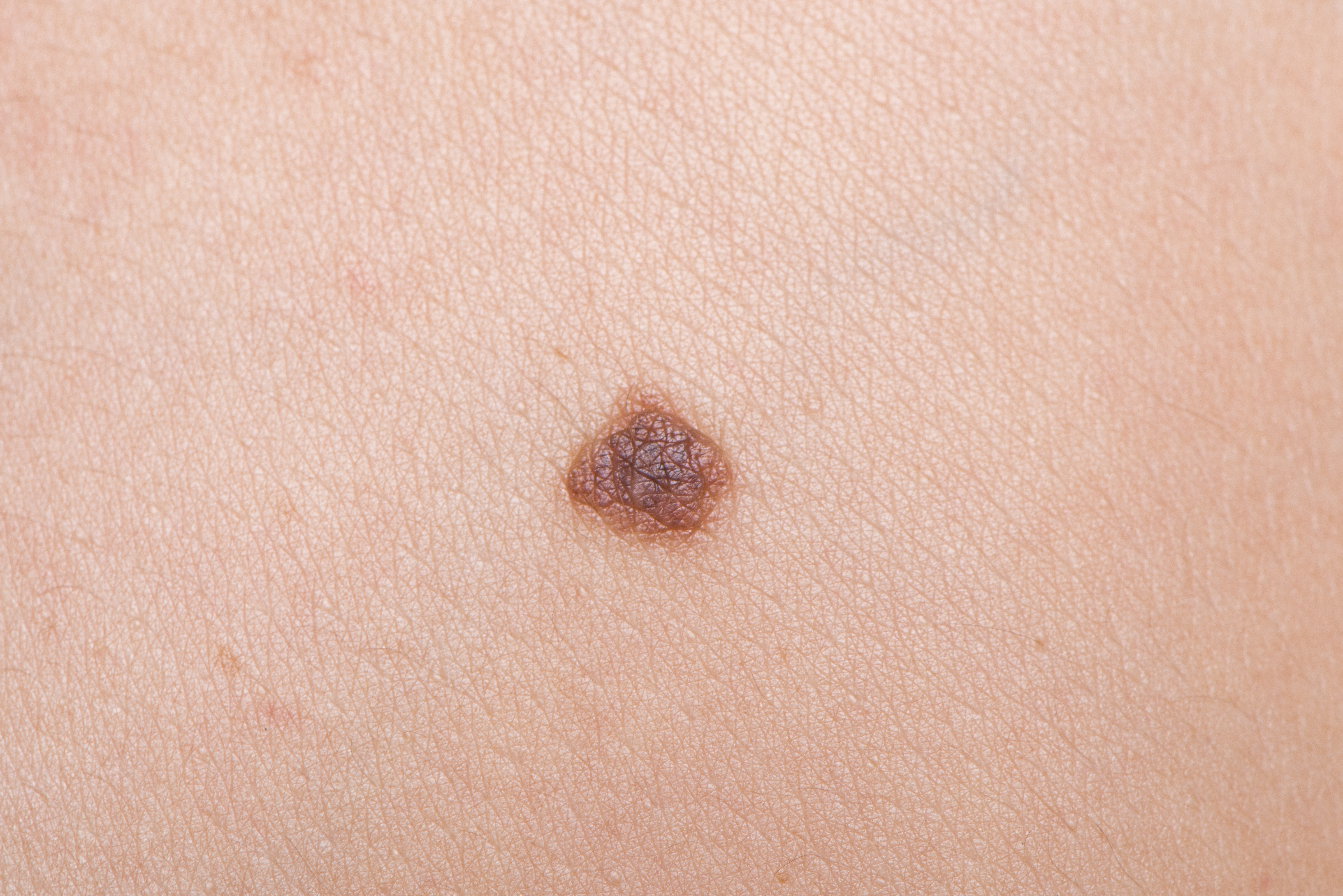 الشامات الميلانينية الوصلية (Junctional melanocytic nevi)