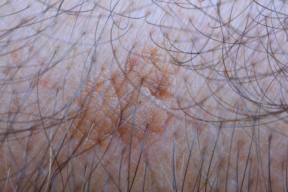 شامات التقرن الدهني (Seborrheic keratosis)