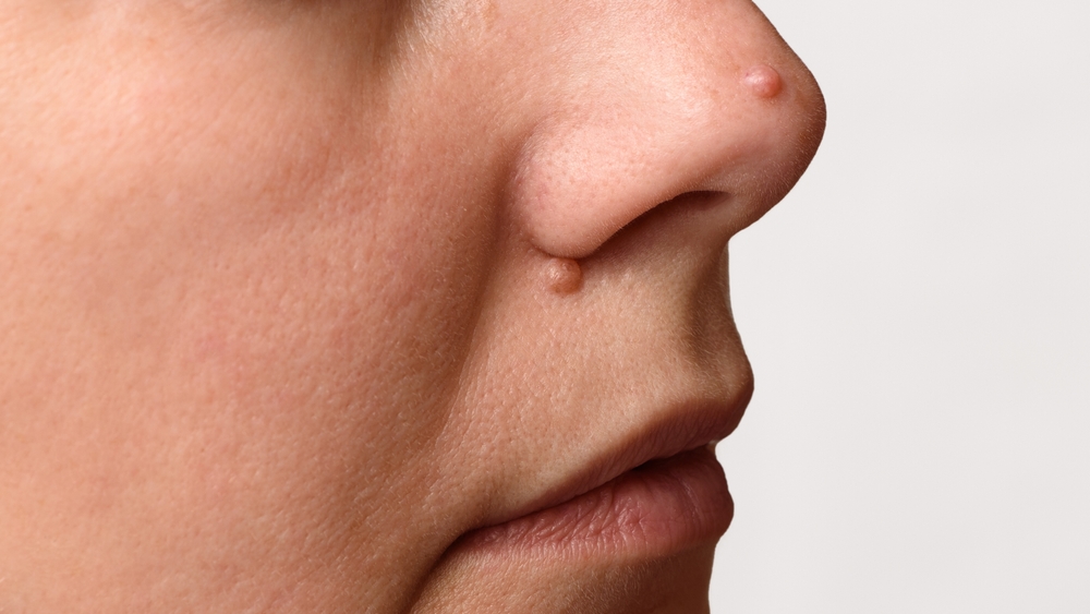 الشامات داخل الأدمة (Intradermal nevi)