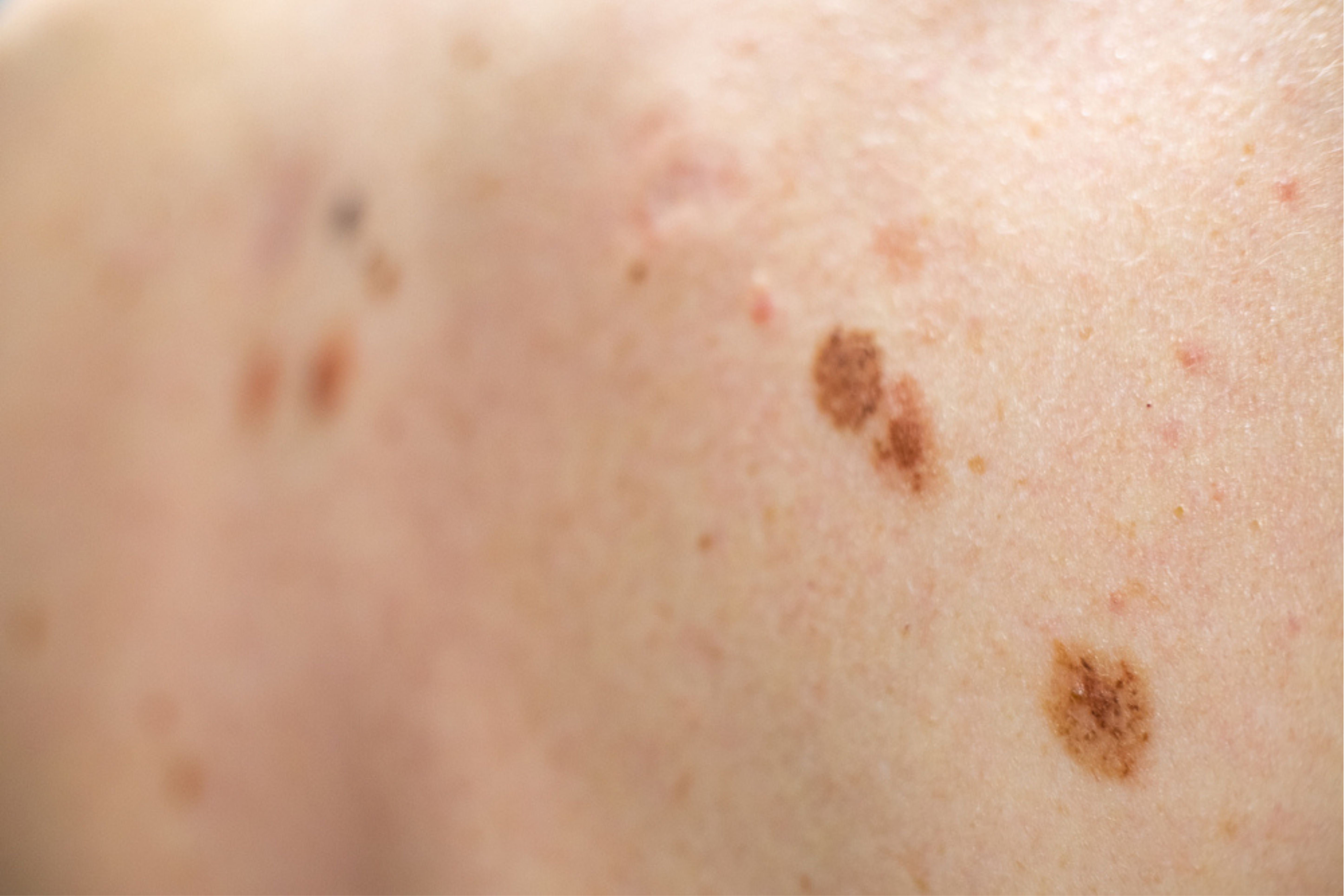 الشامات اللانمطية (Atypical moles)